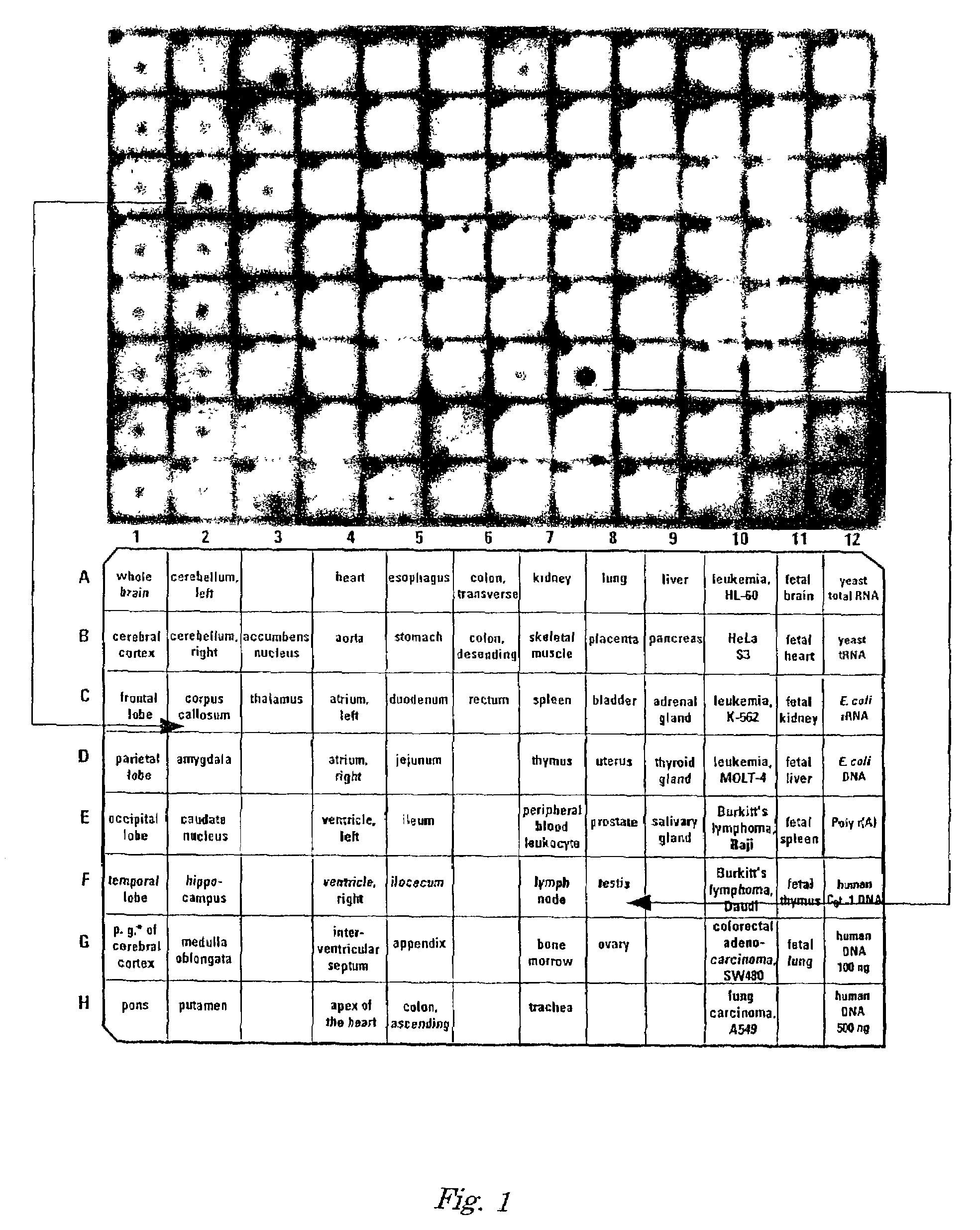 Gene useful for diagnosis and treatment of aplasia of corpus callosum and aspermatogenesis and use thereof