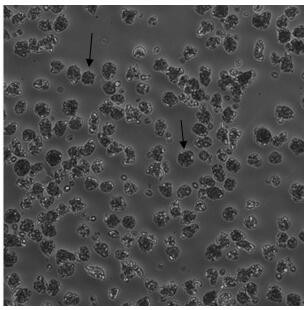 A method for directed differentiation of autologous immune cells into islet cells