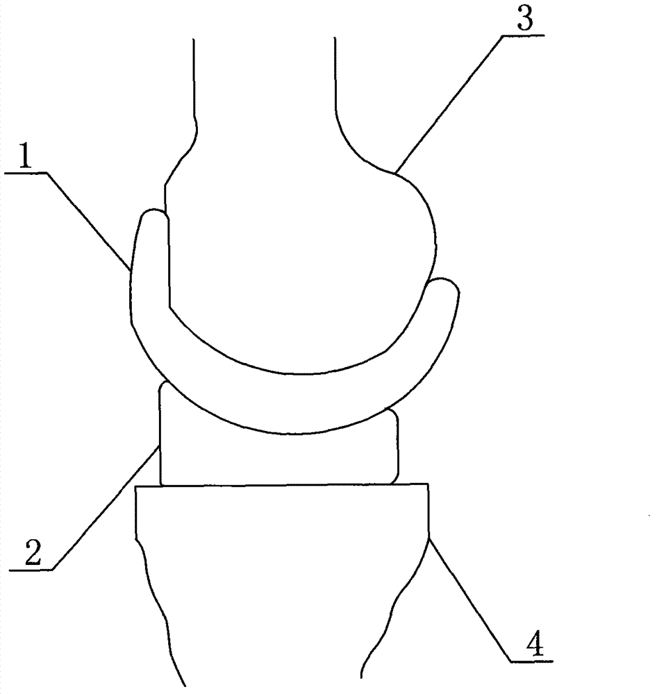 Movable joint spacer for infection after total knee replacement