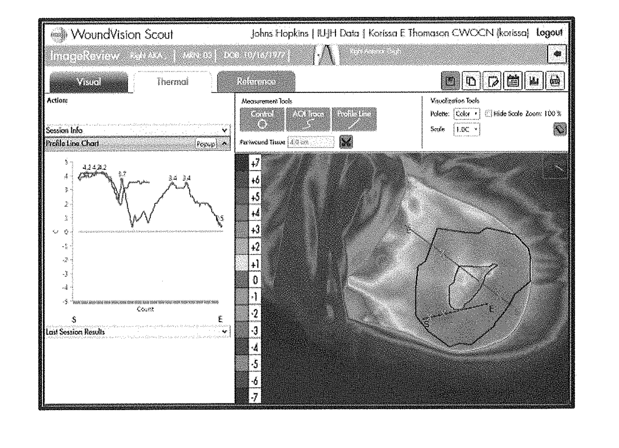 Method of quantifying ischemia/perfusion and blood flow abnormalities