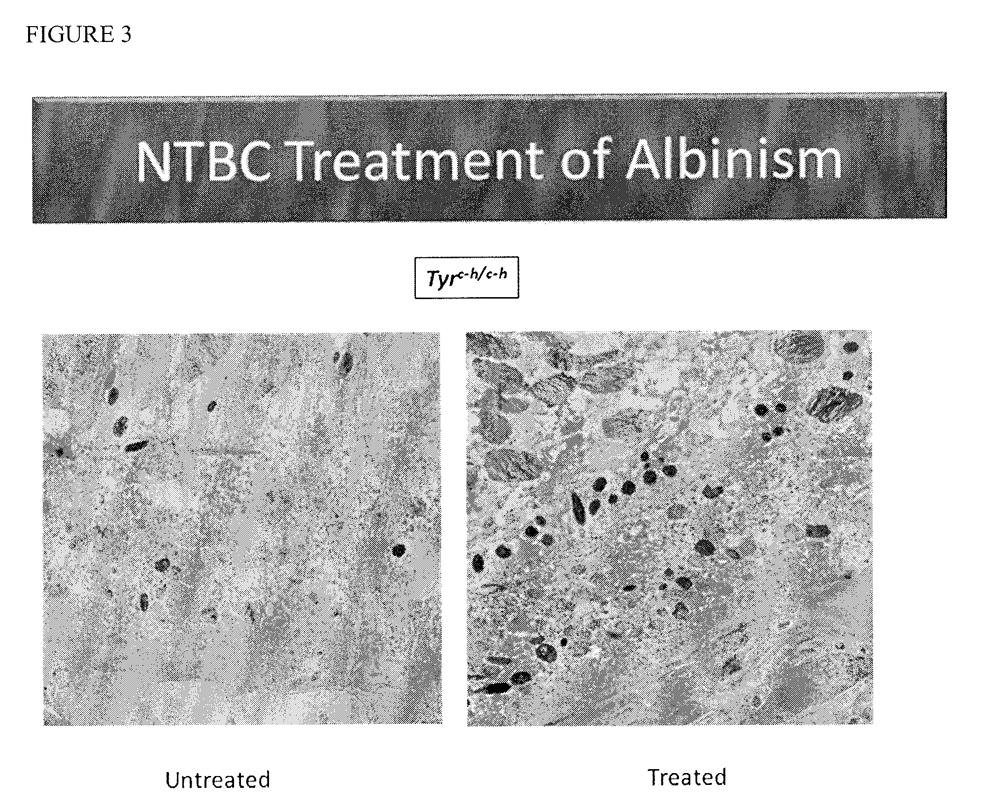 Nitisinone for treatment of oculocutaneous/ocular albinism and for increasing pigmentation