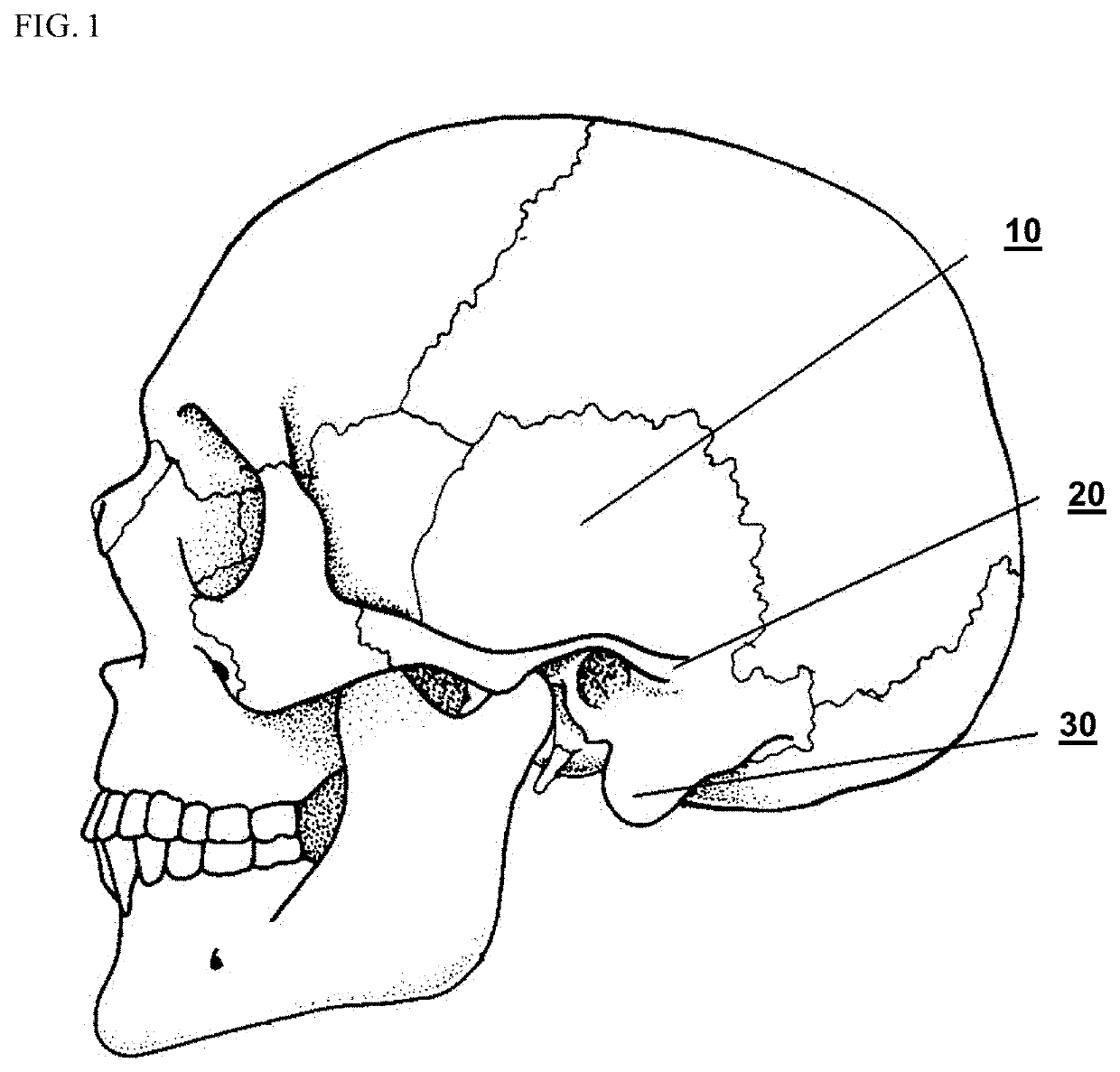 Bruxism detection and correction device