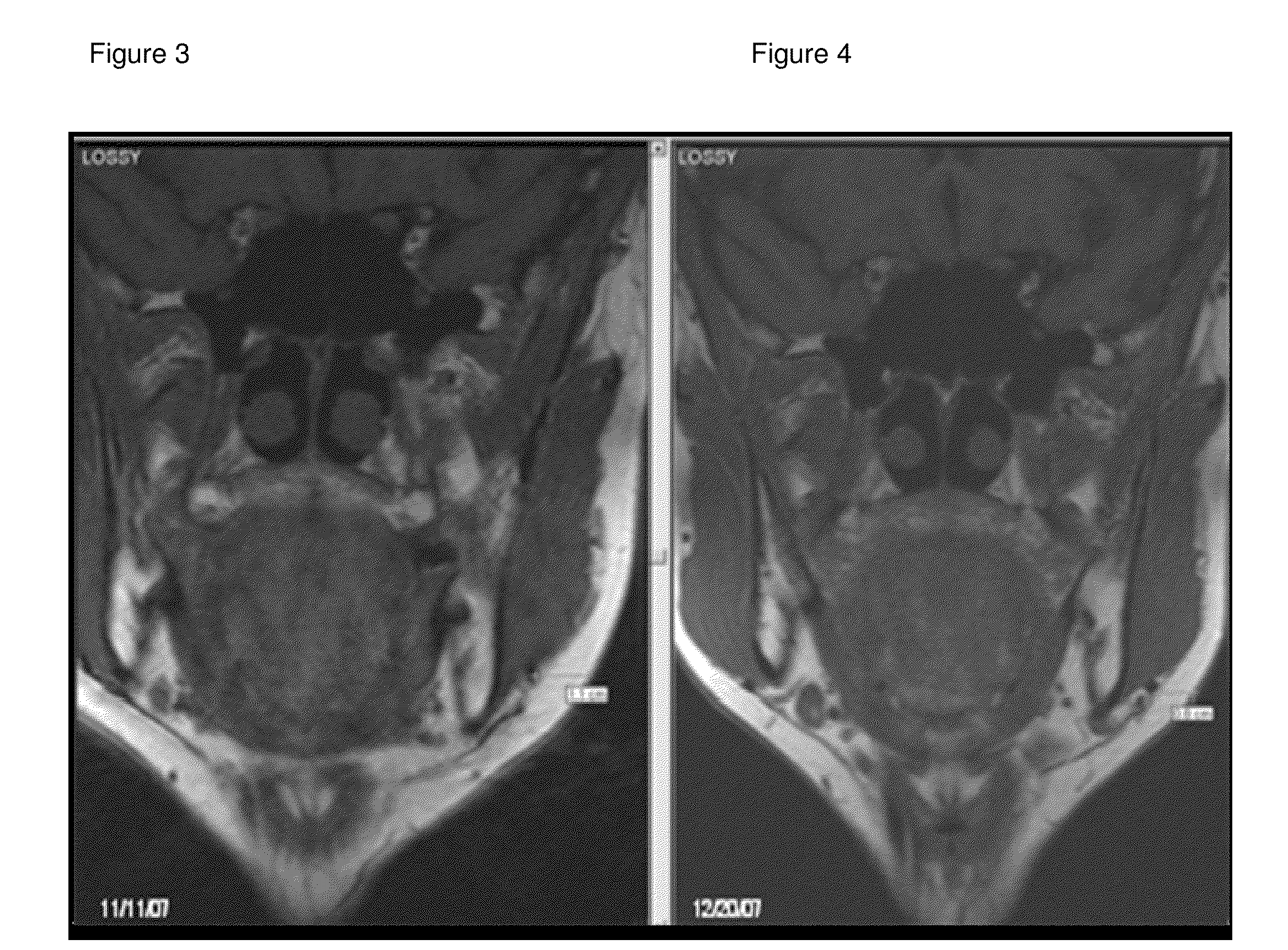 Medicinal cosmetic lipoatrophy