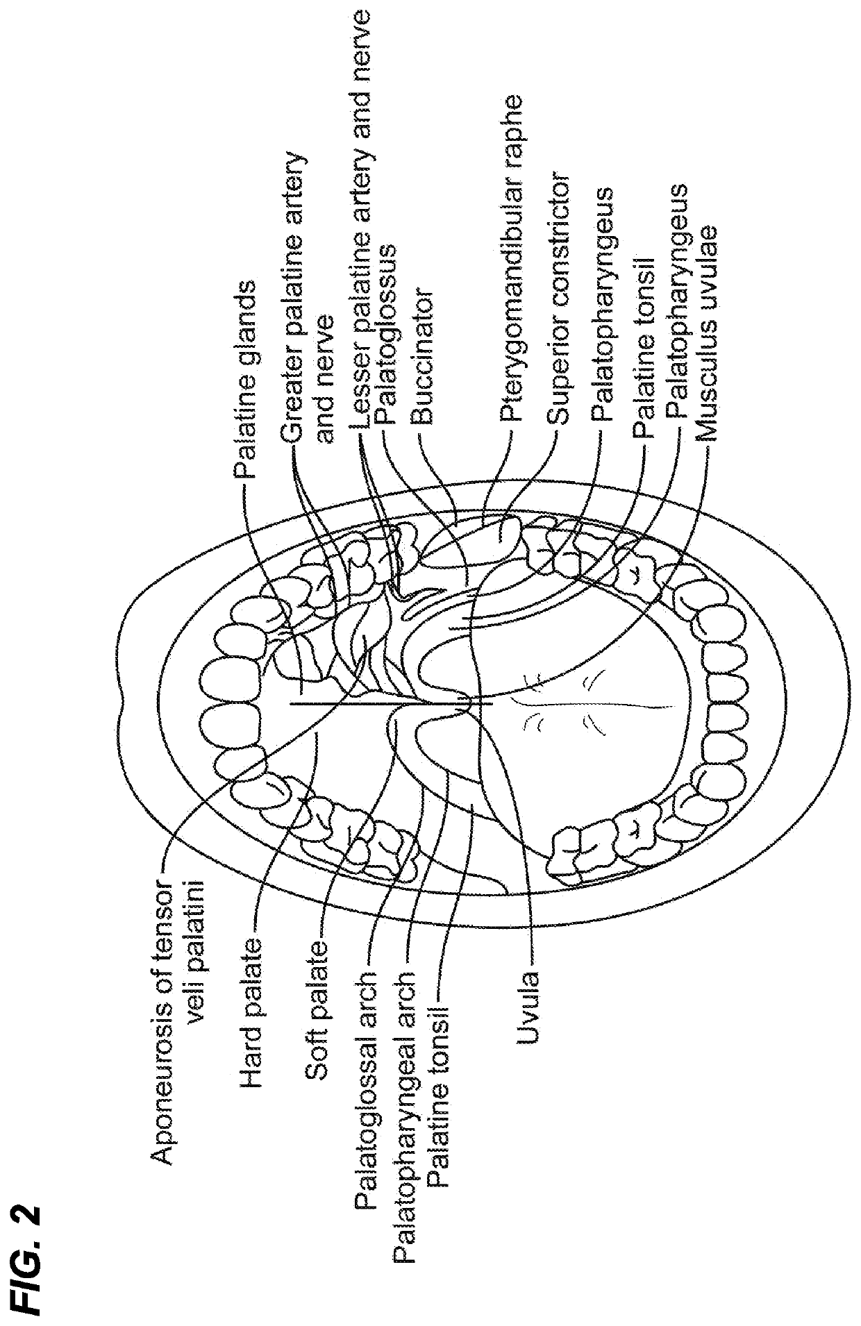 Soft palate treatment