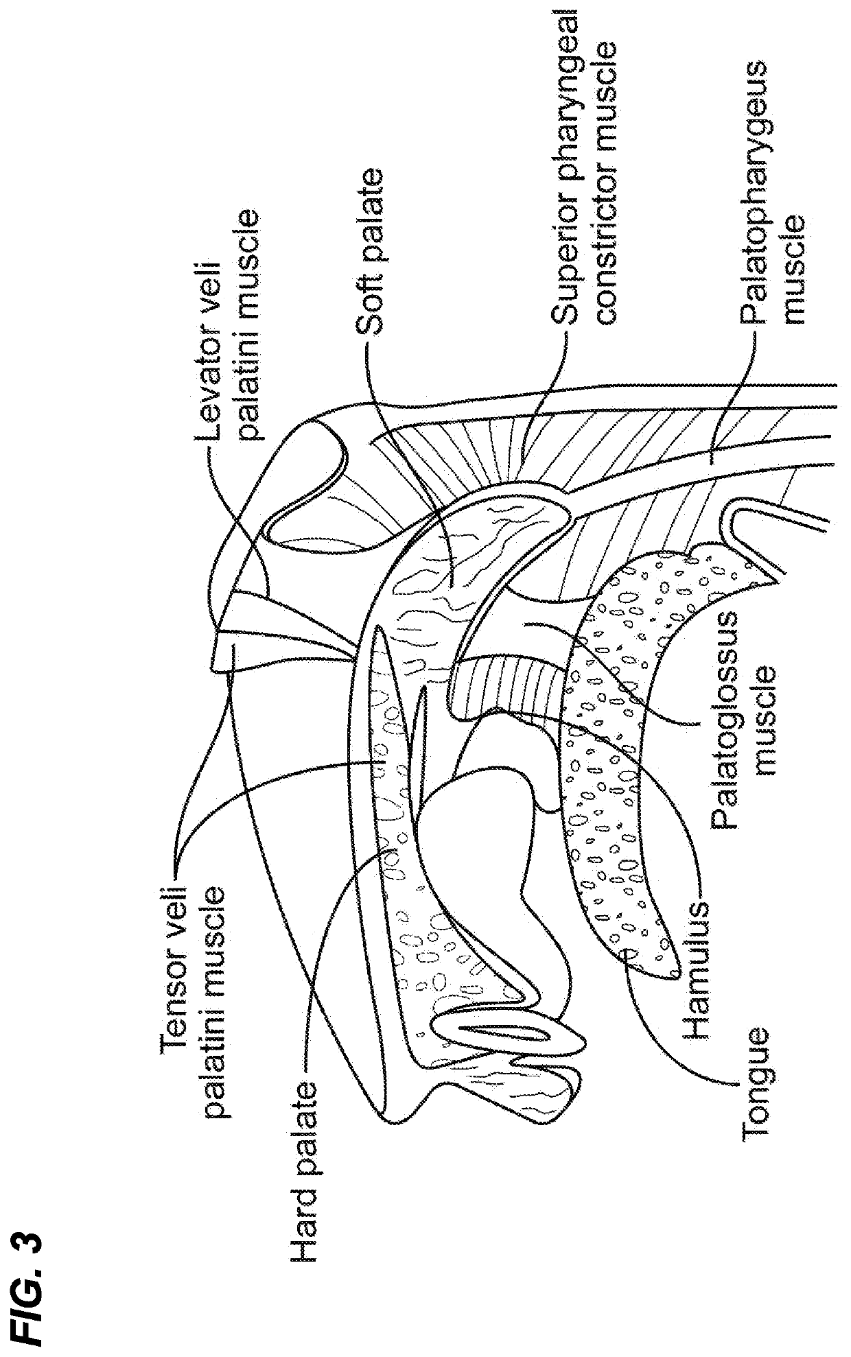 Soft palate treatment