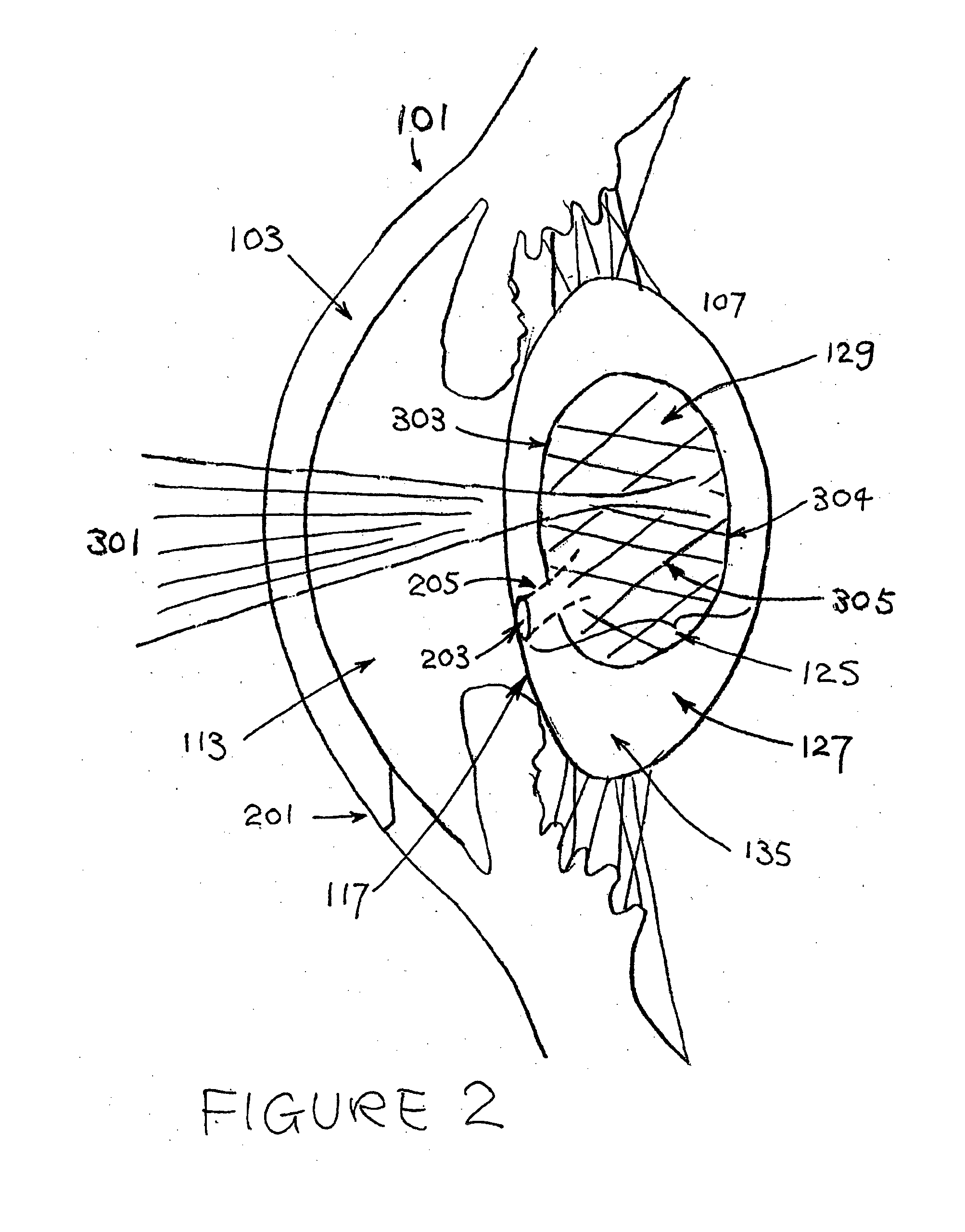 Restoration of accommodation by lens refilling