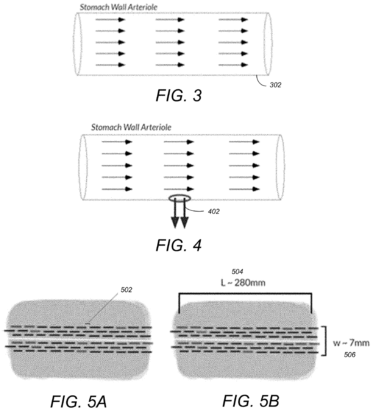 Automatic suture device to reduce bleeding in  gastric bypass surgery