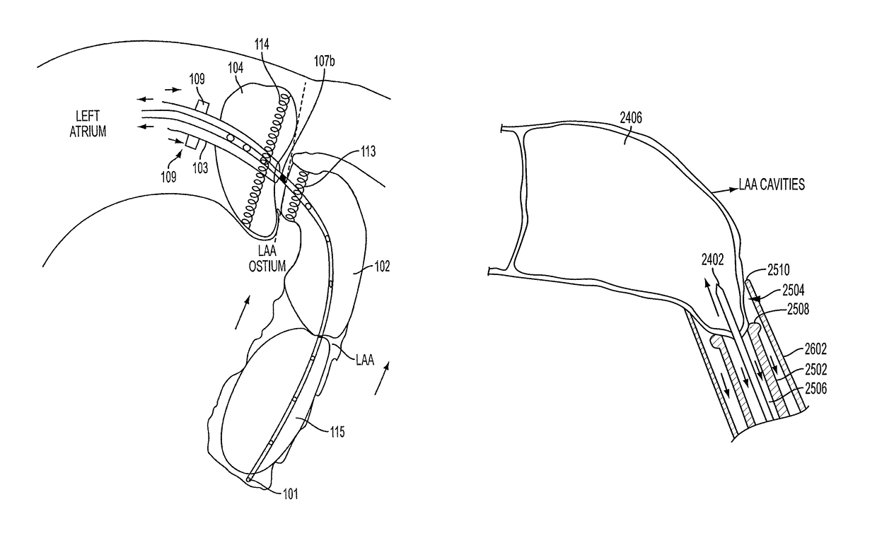 Methods and systems for preventing bleeding from the left atrial appendage