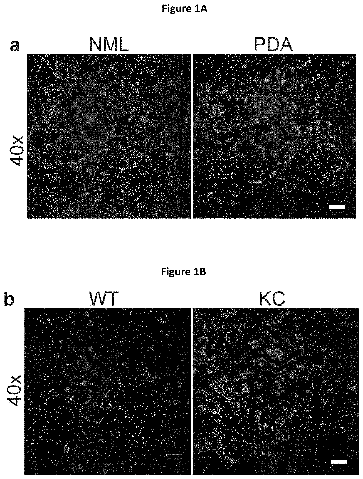 Methods and compositions for treating and diagnosing pancreatic cancers