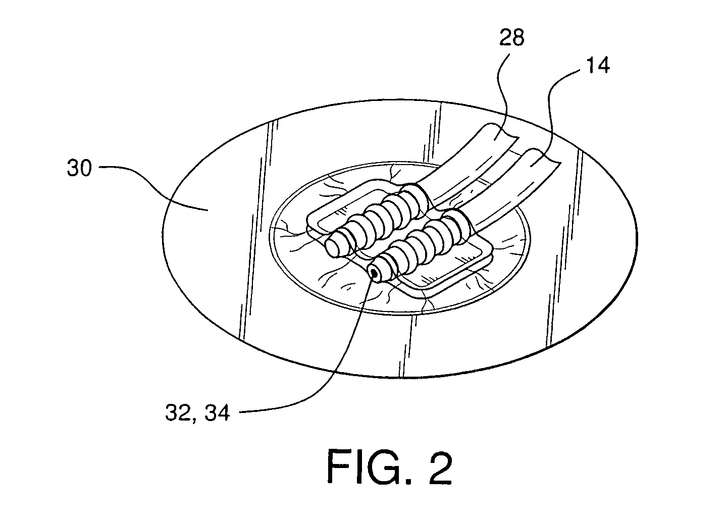 Pump system for negative pressure wound therapy