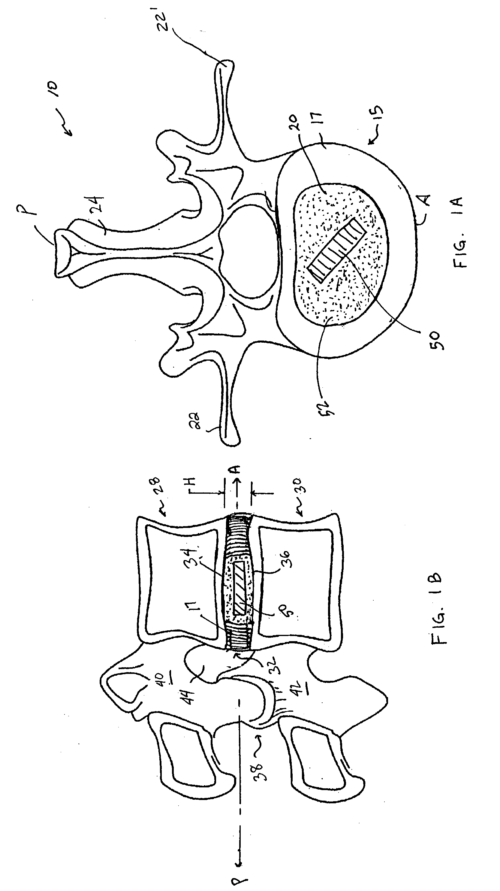 Devices and method for augmenting a vertebral disc