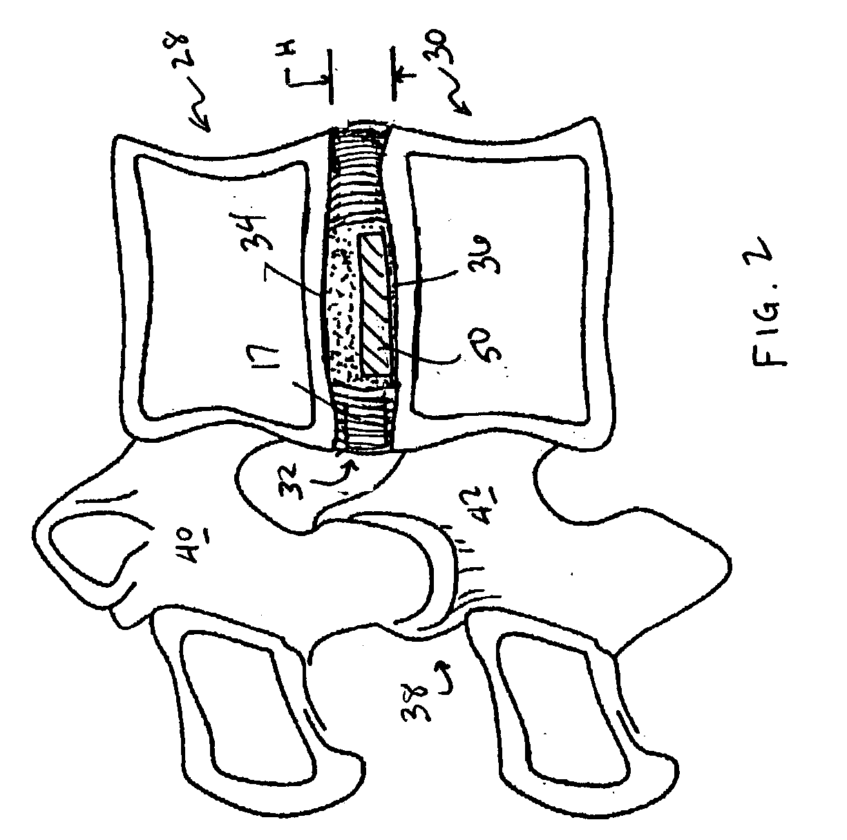 Devices and method for augmenting a vertebral disc