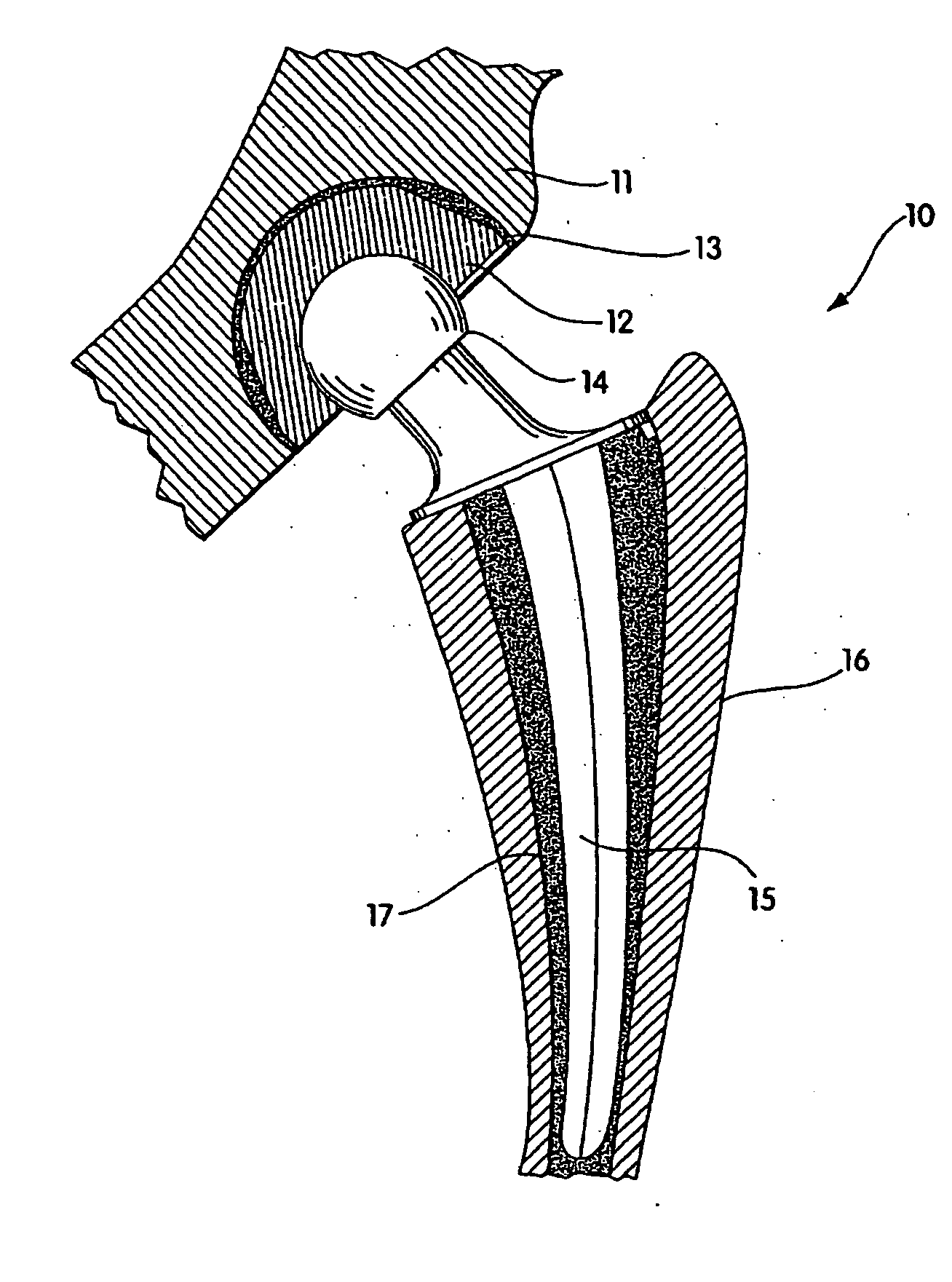 Radiation melt treated ultra high molecular weight polyethylene prosthetic devices