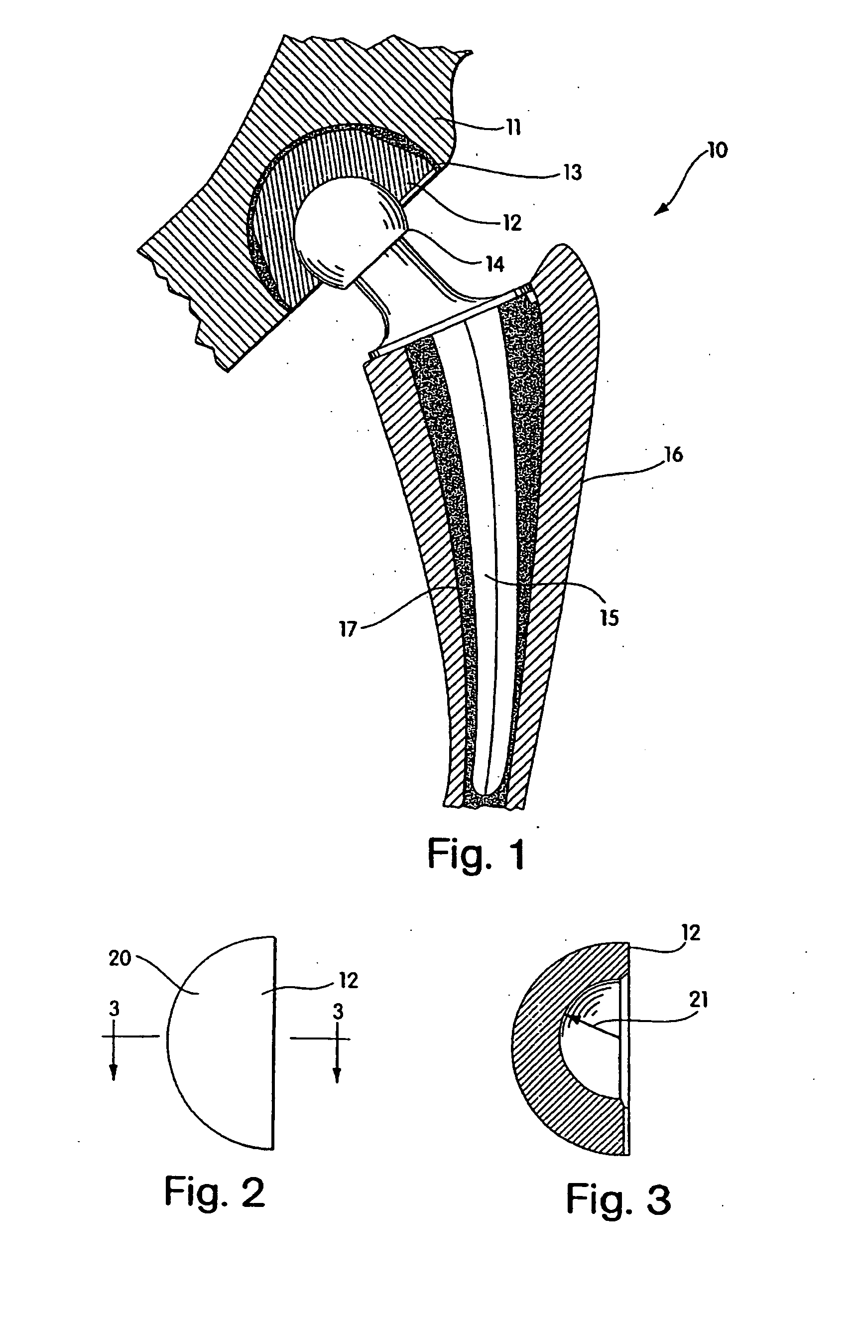 Radiation melt treated ultra high molecular weight polyethylene prosthetic devices