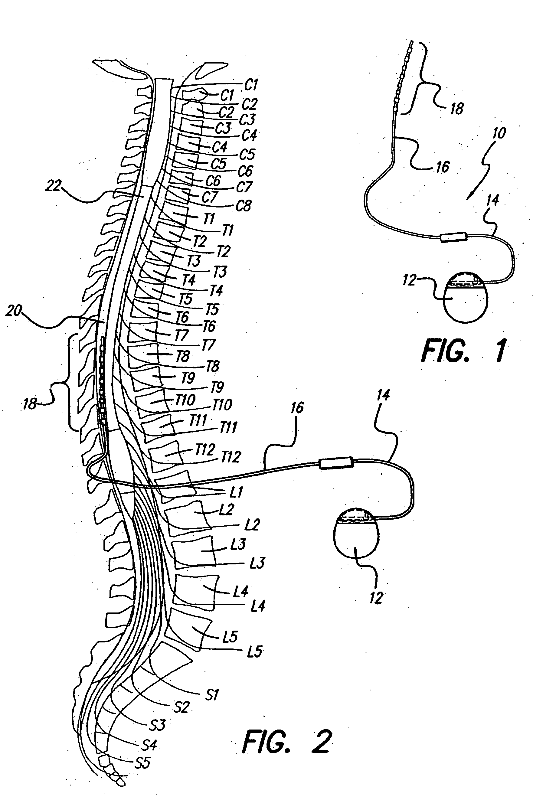 Expanding single channel stimulator capability on multi-area stimulation programs