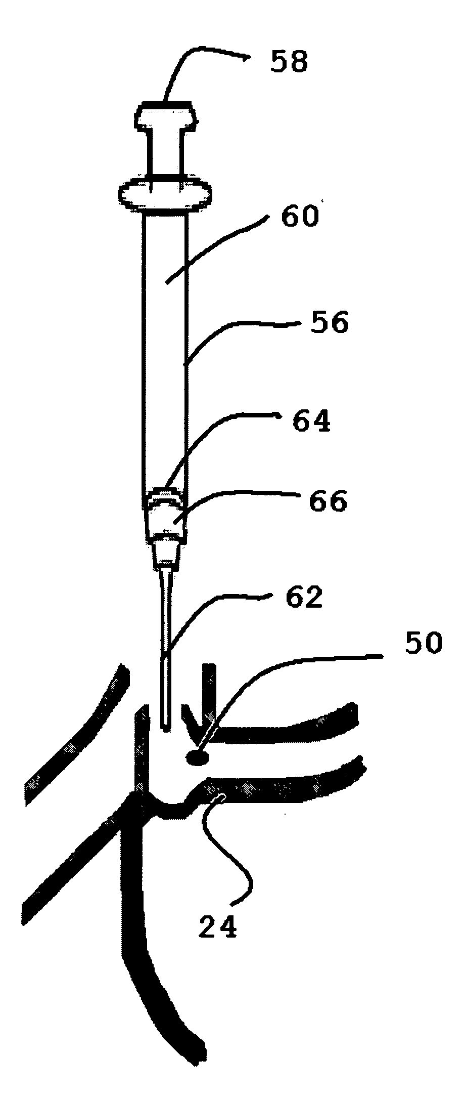 Lacrimal filler