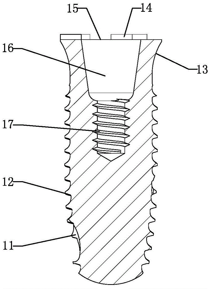 Anti-rotation implant device