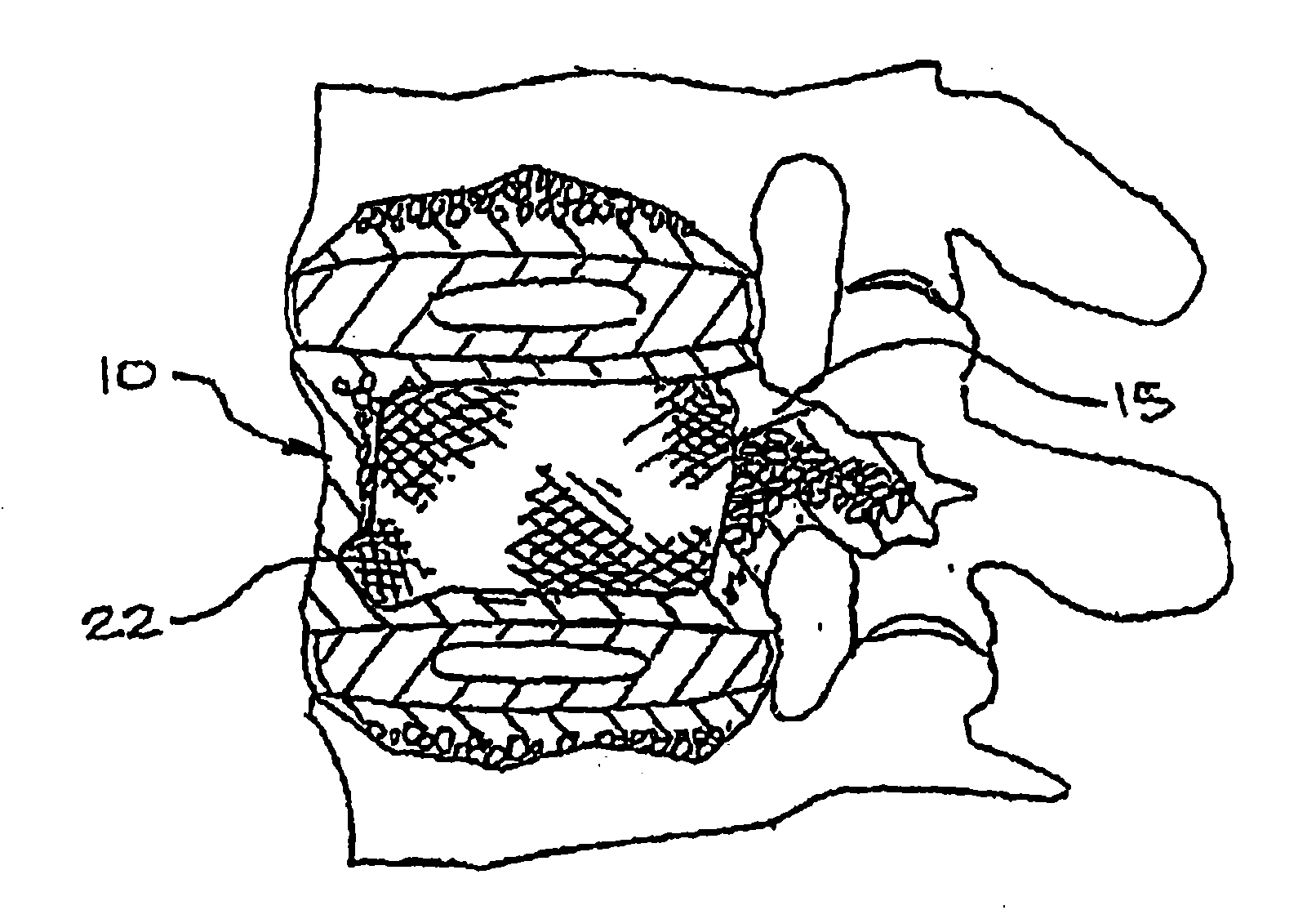 Expandable porous mesh bag device and methods of use for reduction, filling, fixation and supporting of bone