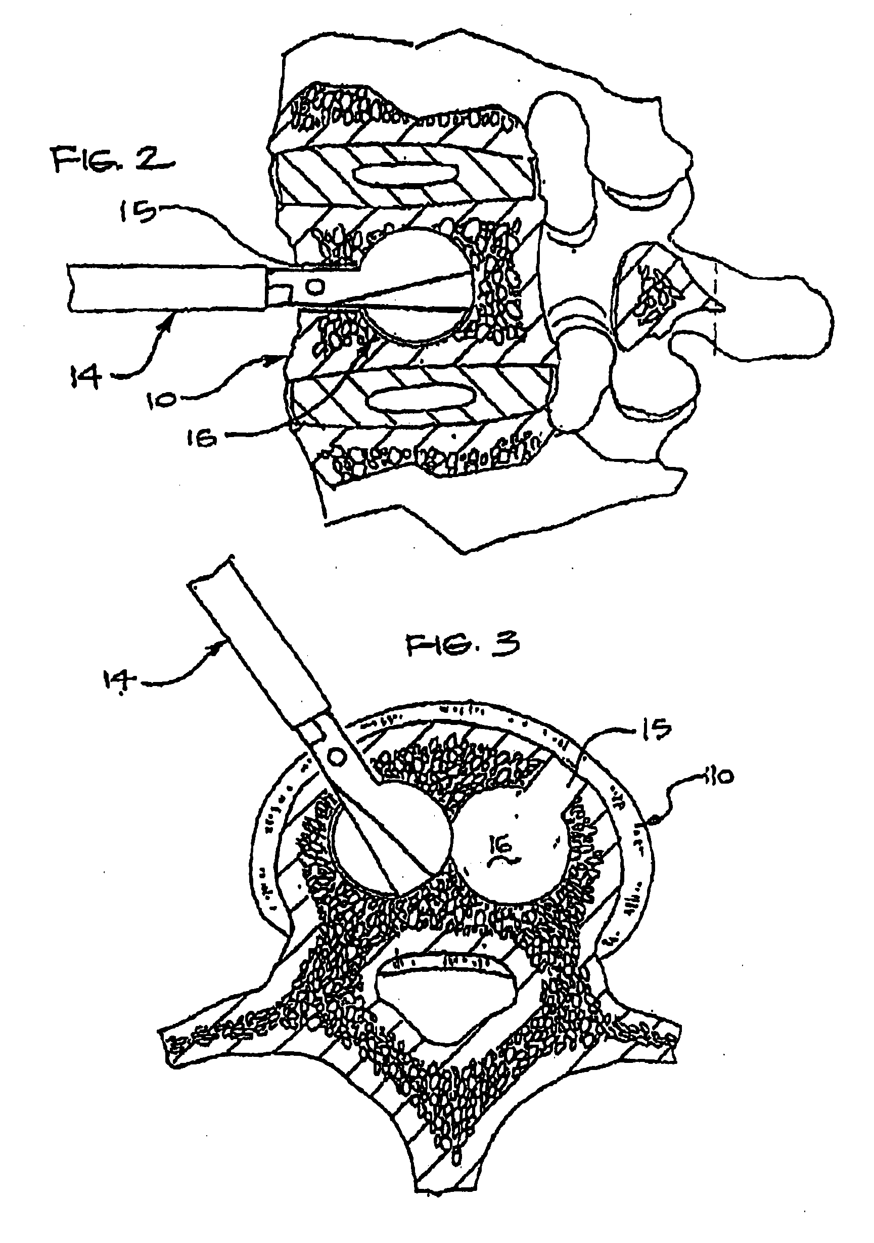 Expandable porous mesh bag device and methods of use for reduction, filling, fixation and supporting of bone