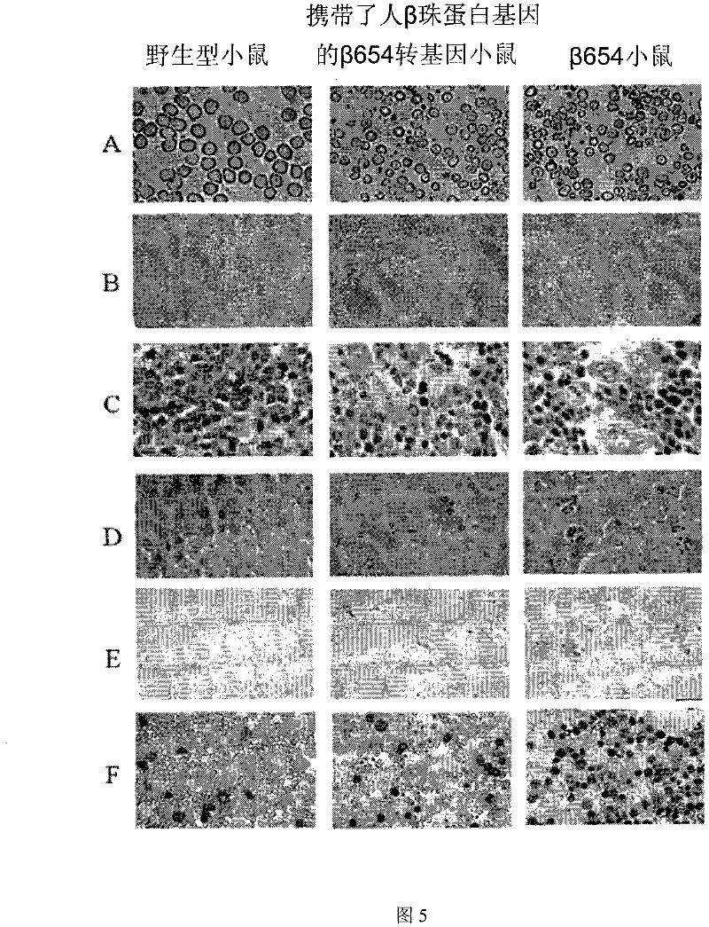 Method for preparing beta IVS-II-654 transgene mouse model carrying human beta globin gene