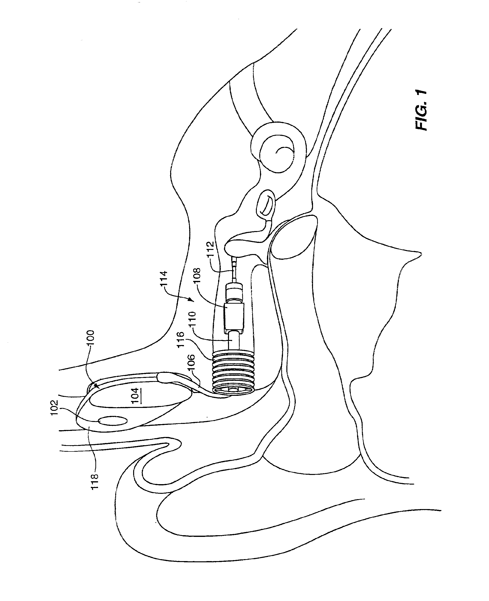 Method and system for external assessment of hearing aids that include implanted actuators