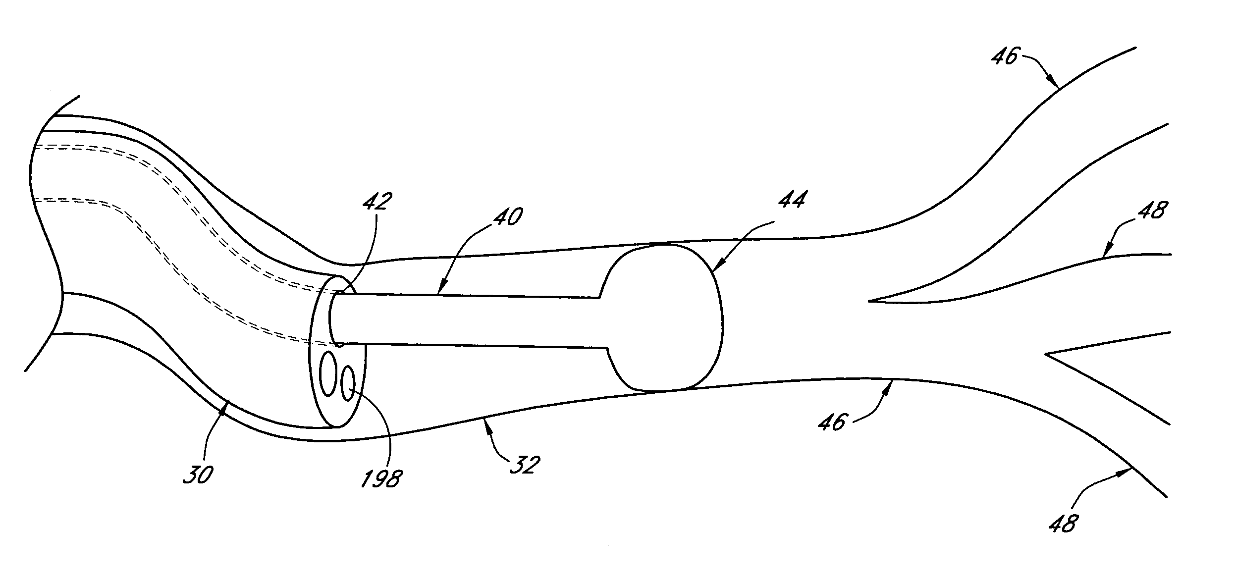 Bronchoscopic repair of air leaks in a lung