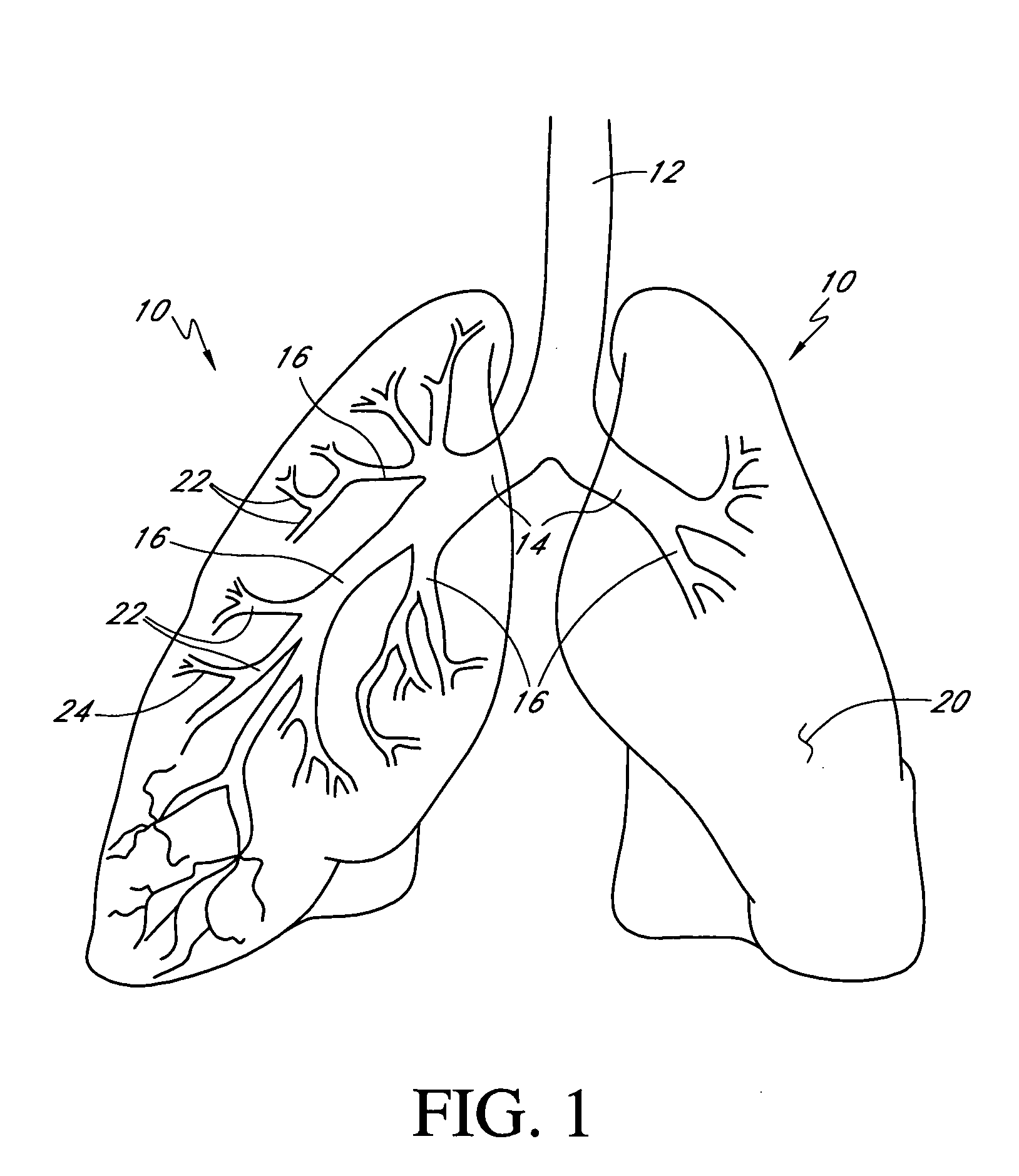 Bronchoscopic repair of air leaks in a lung