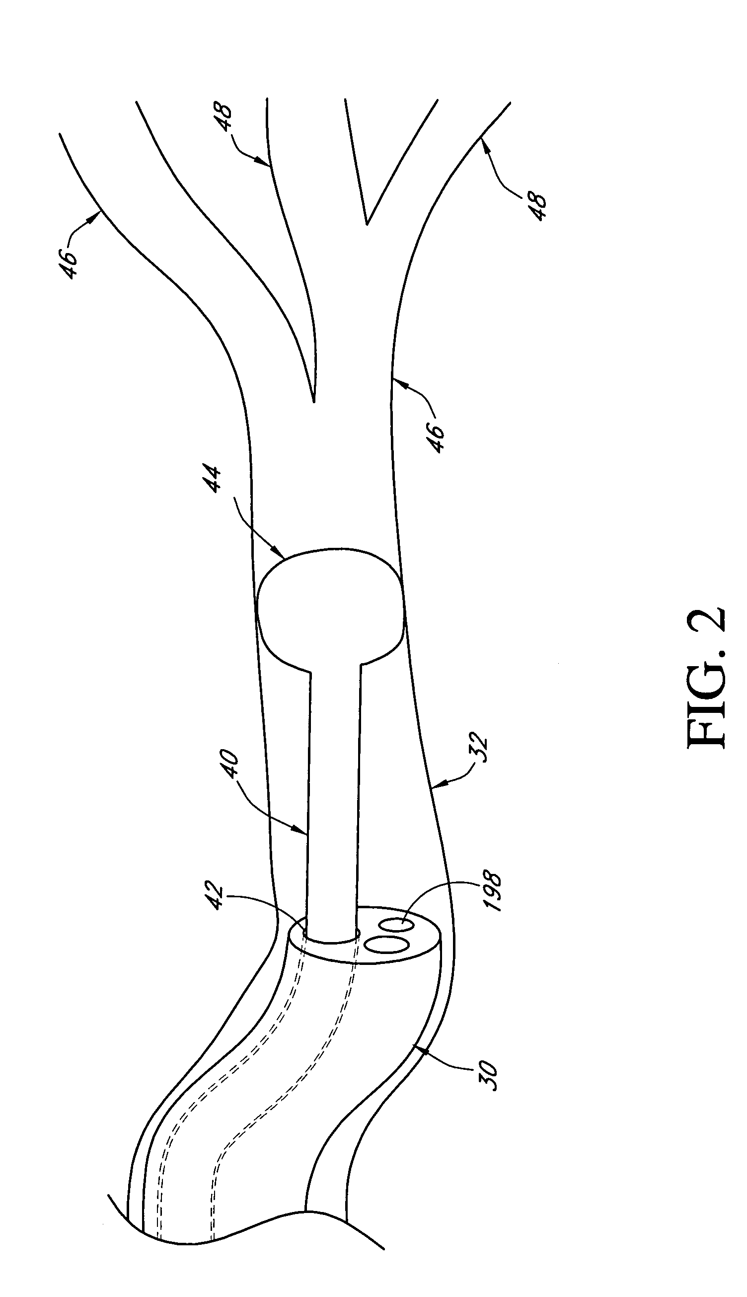 Bronchoscopic repair of air leaks in a lung