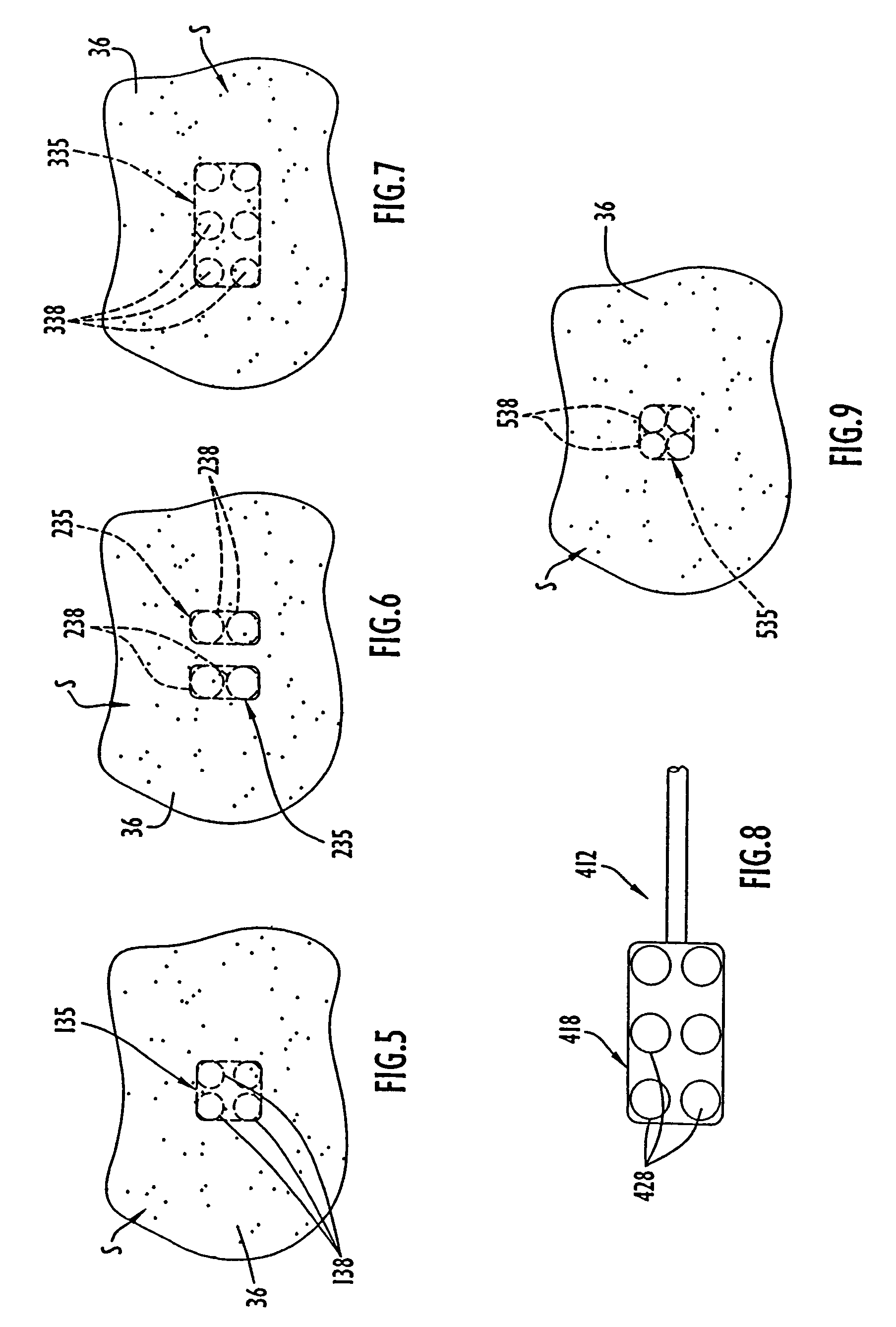 Methods of using high intensity focused ultrasound to form an ablated tissue area