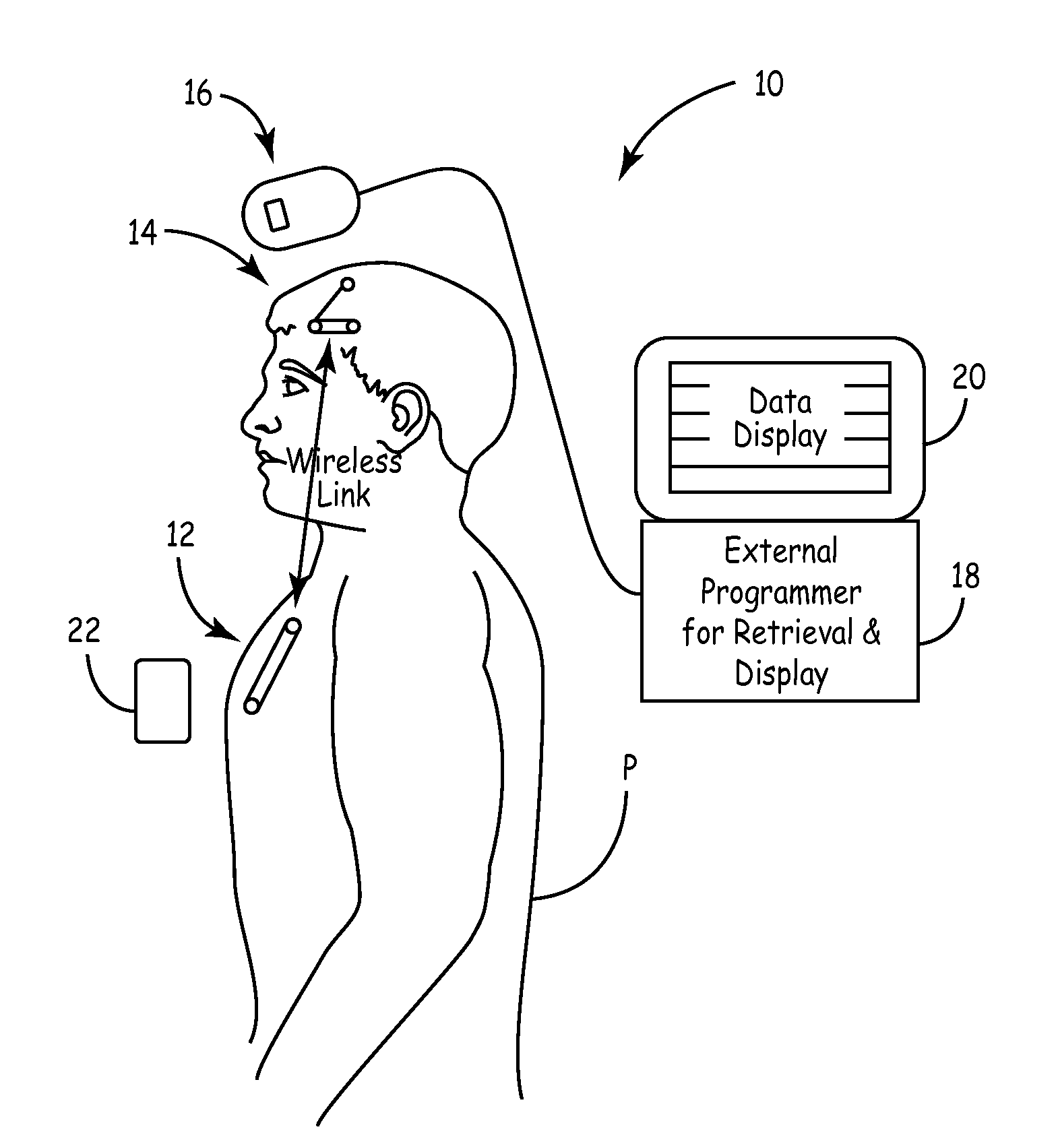 Telemetry-synchronized physiological monitoring and therapy delivery systems