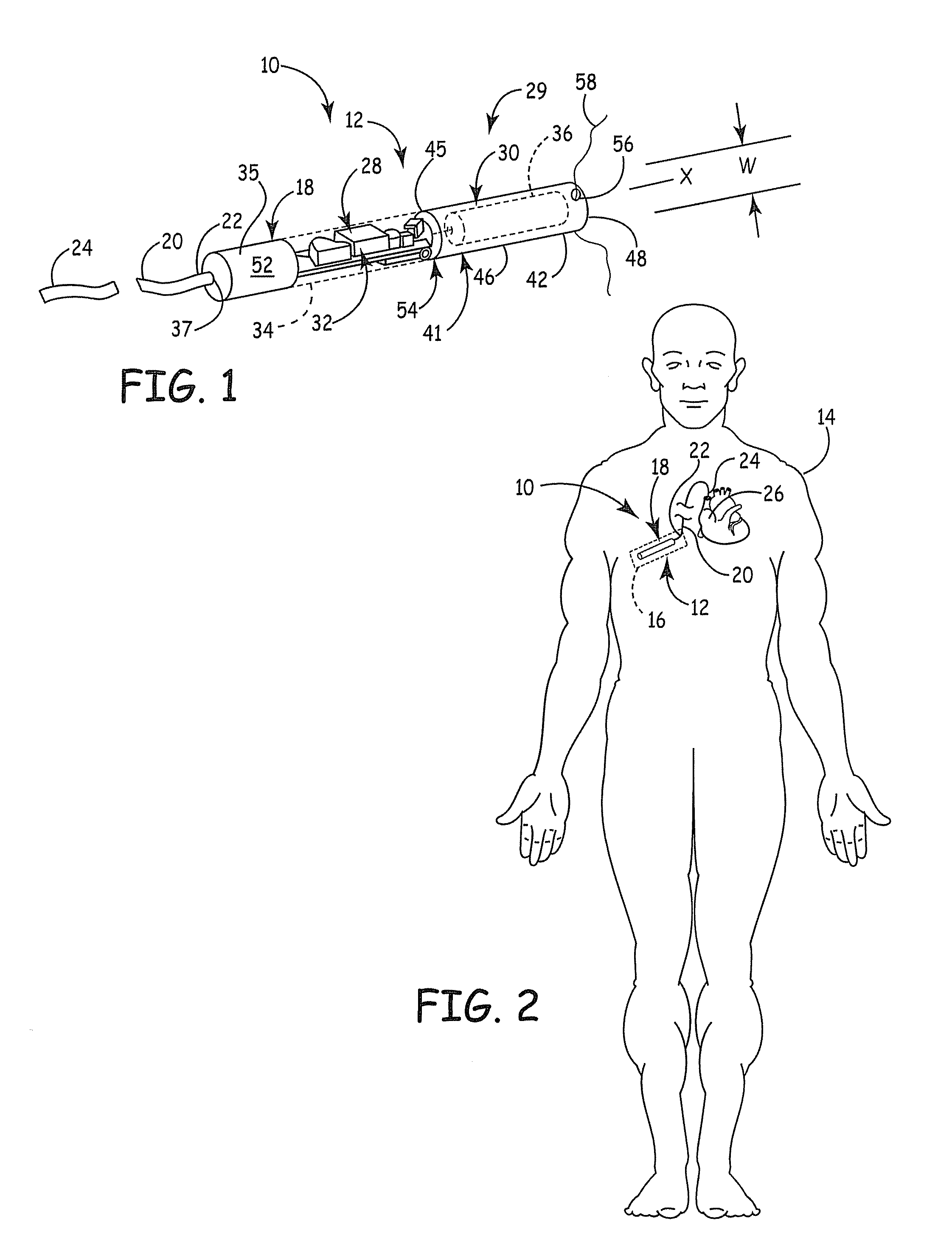 Battery with suture hole