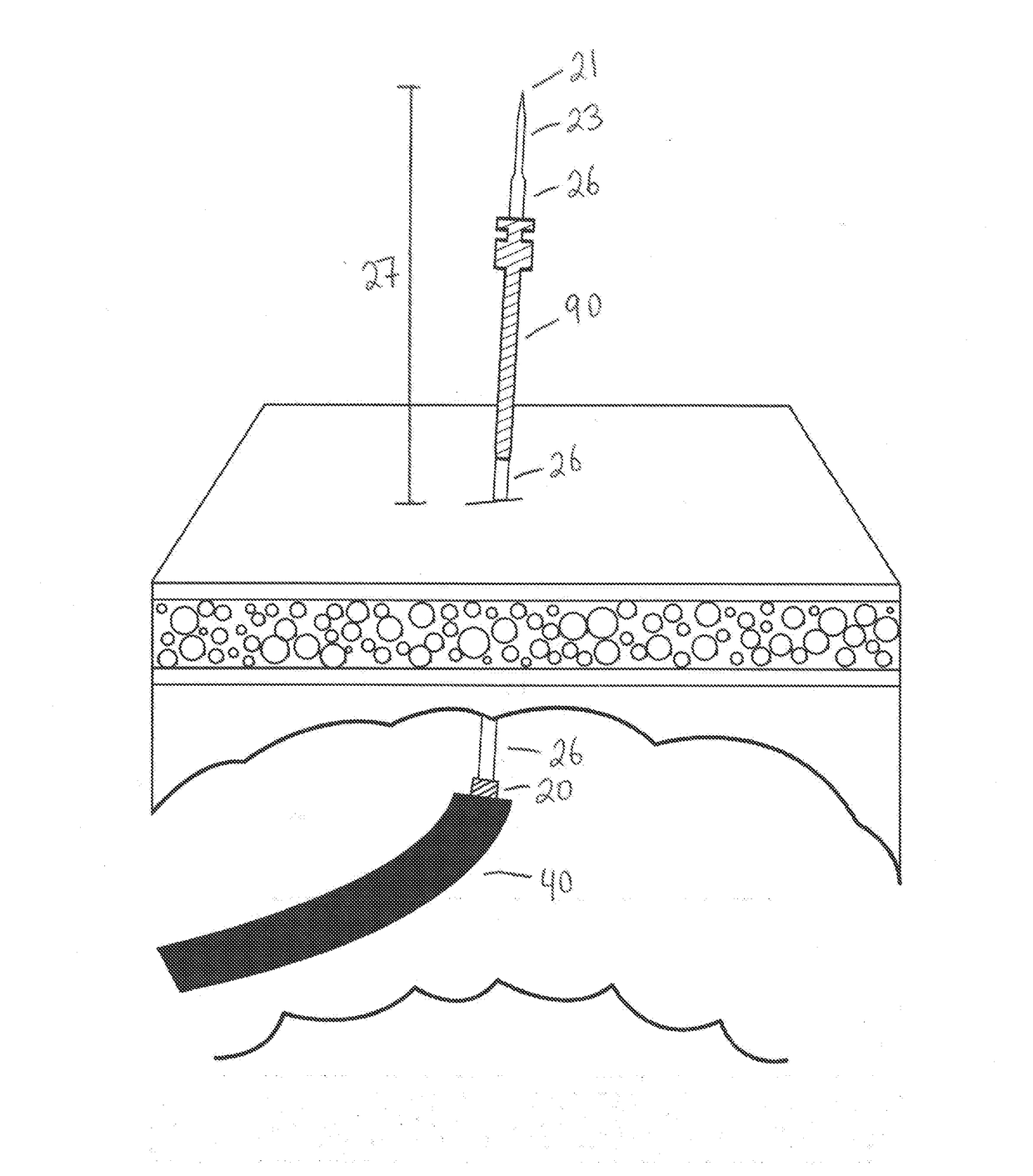 Percutaneous Gastrointestinal Access System and Method