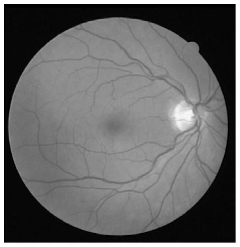 A Retinal Vessel Segmentation System Based on Combination of Hessian Matrix and Region Growing