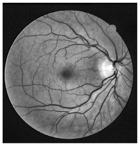 A Retinal Vessel Segmentation System Based on Combination of Hessian Matrix and Region Growing