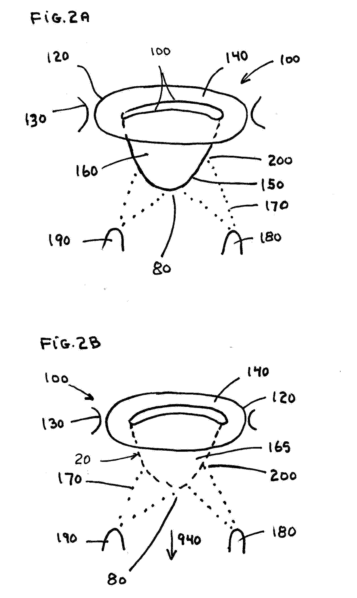 Free Edge Supported Mitral Valve