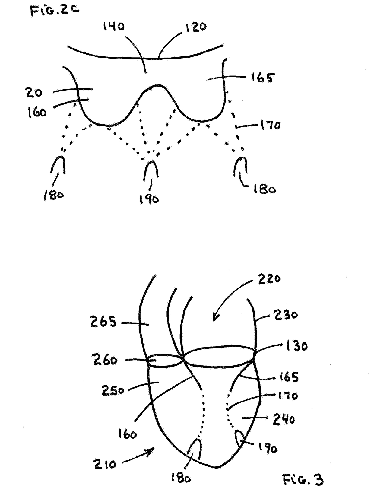 Free Edge Supported Mitral Valve