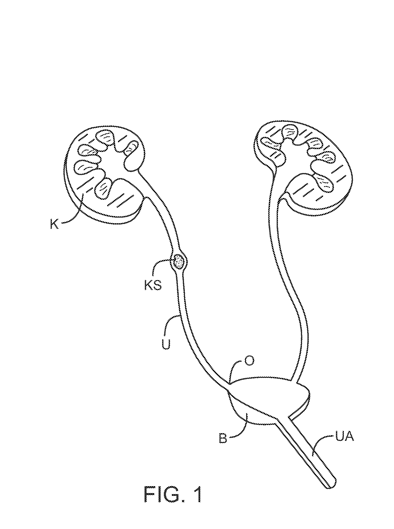 Methods for removing kidney stones from the ureter