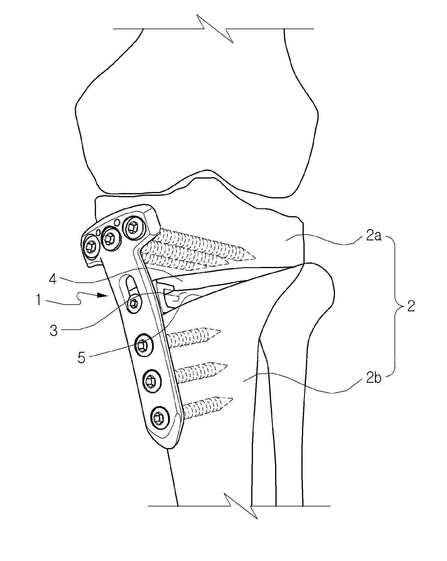 Fixing tool for open-wedge high tibial osteotomy