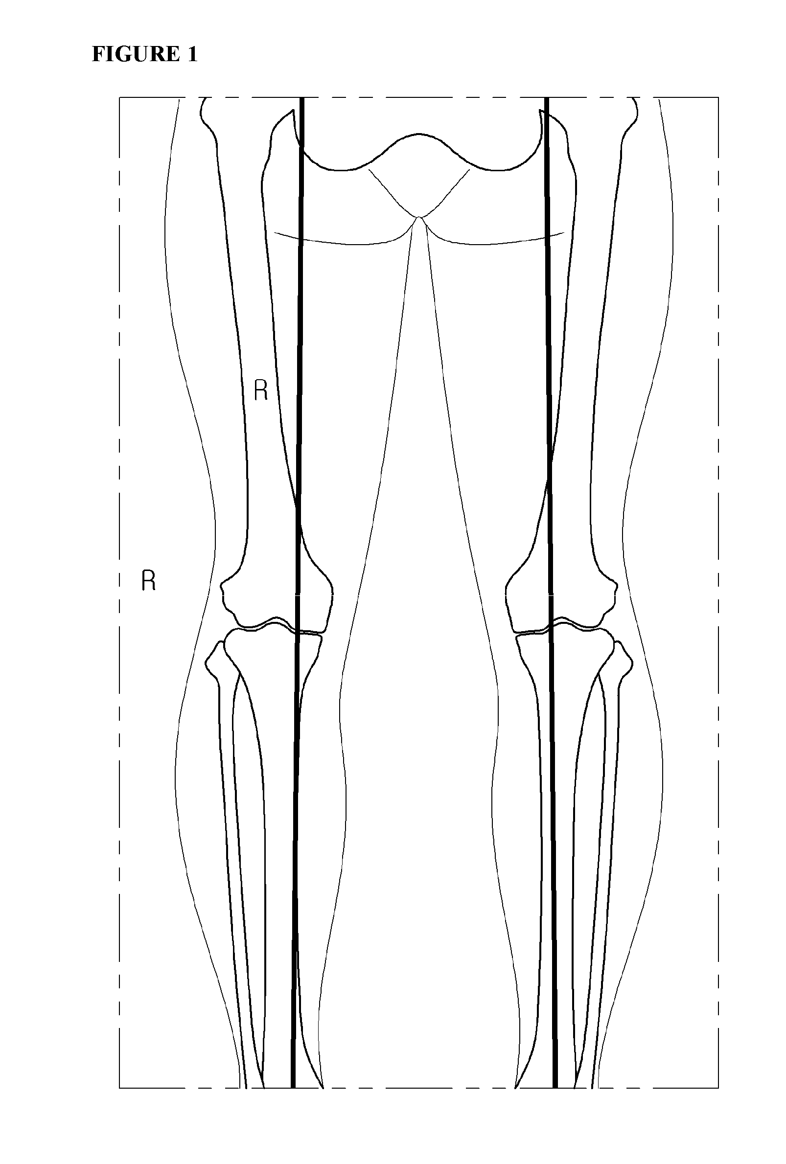 Fixing tool for open-wedge high tibial osteotomy