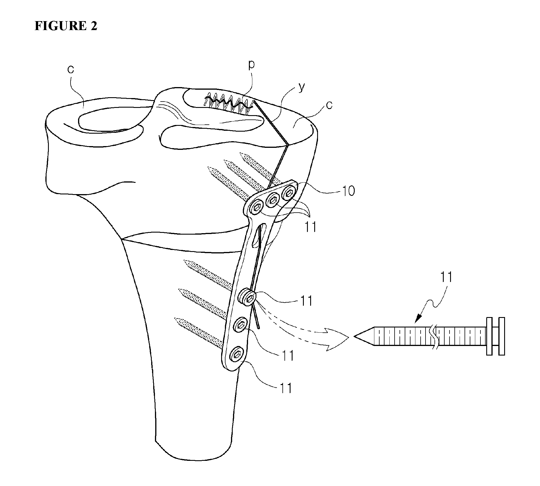 Fixing tool for open-wedge high tibial osteotomy