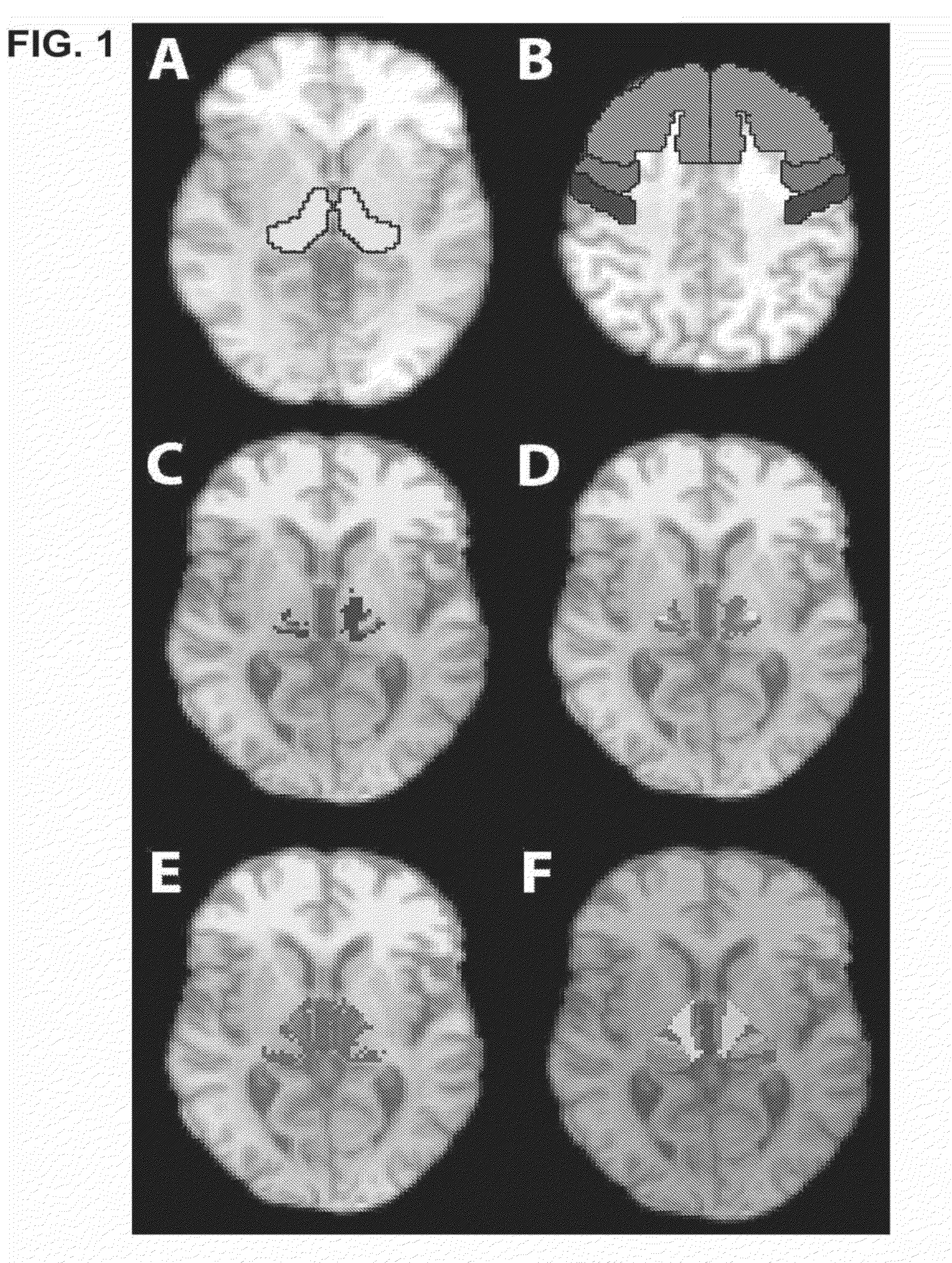 Method for deep brain stimulation targeting based on brain connectivity