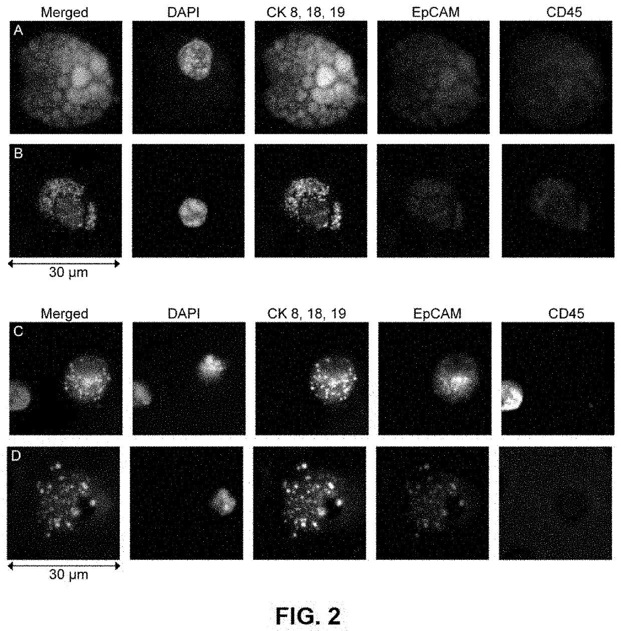 Capture, identification and use of a new biomarker of solid tumors in body fluids