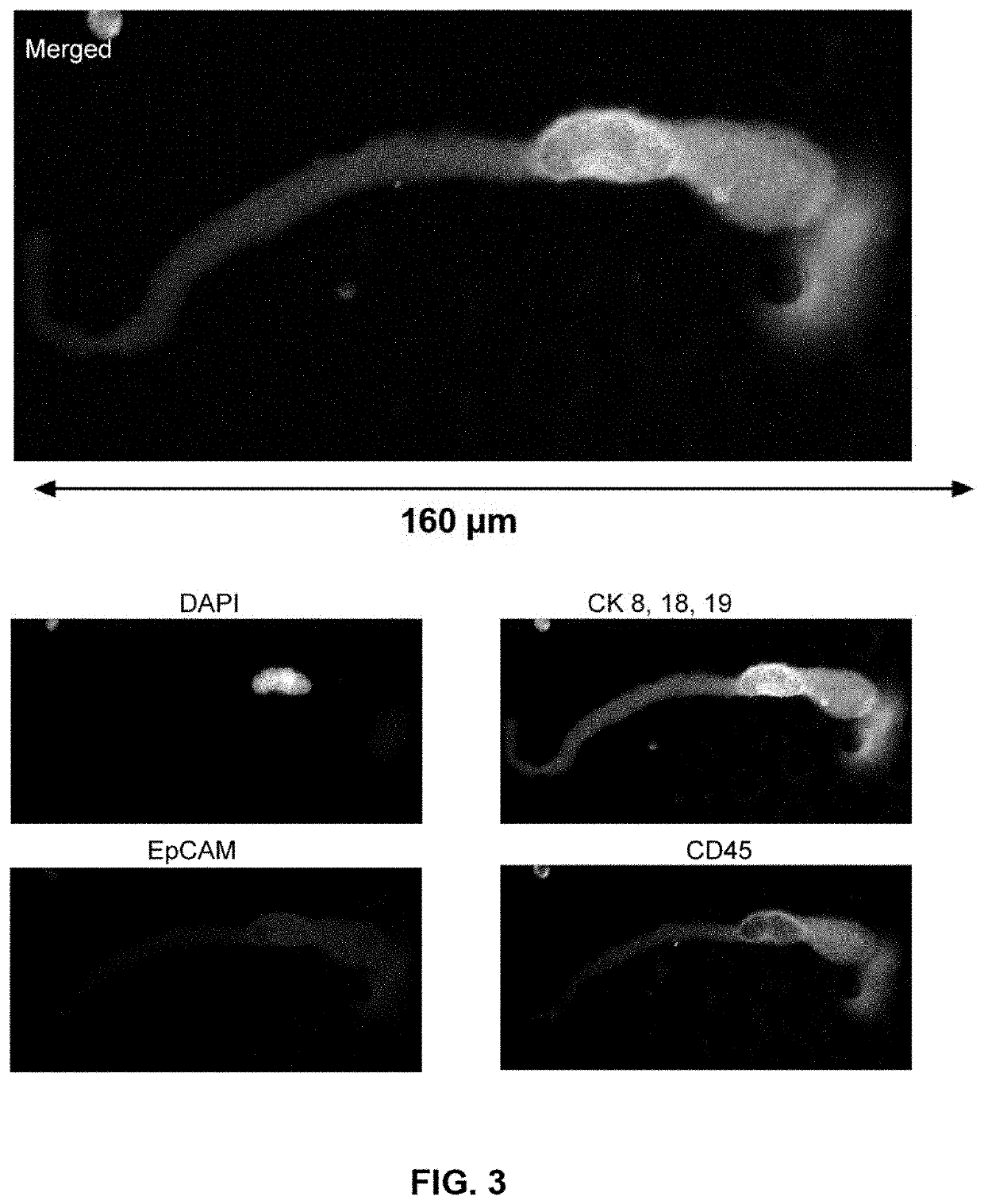 Capture, identification and use of a new biomarker of solid tumors in body fluids