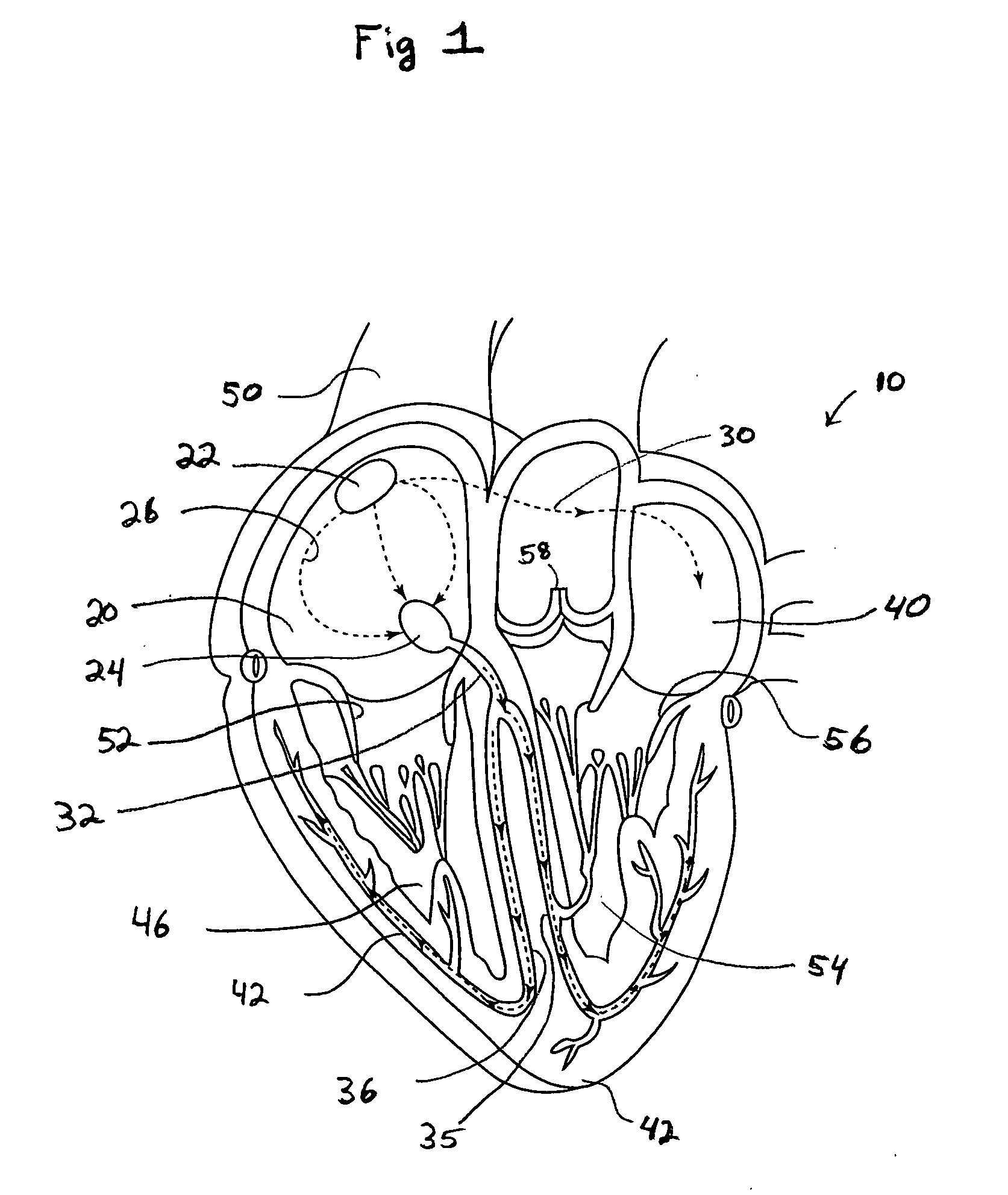 System and method of AV interval selection in an implantable medical device