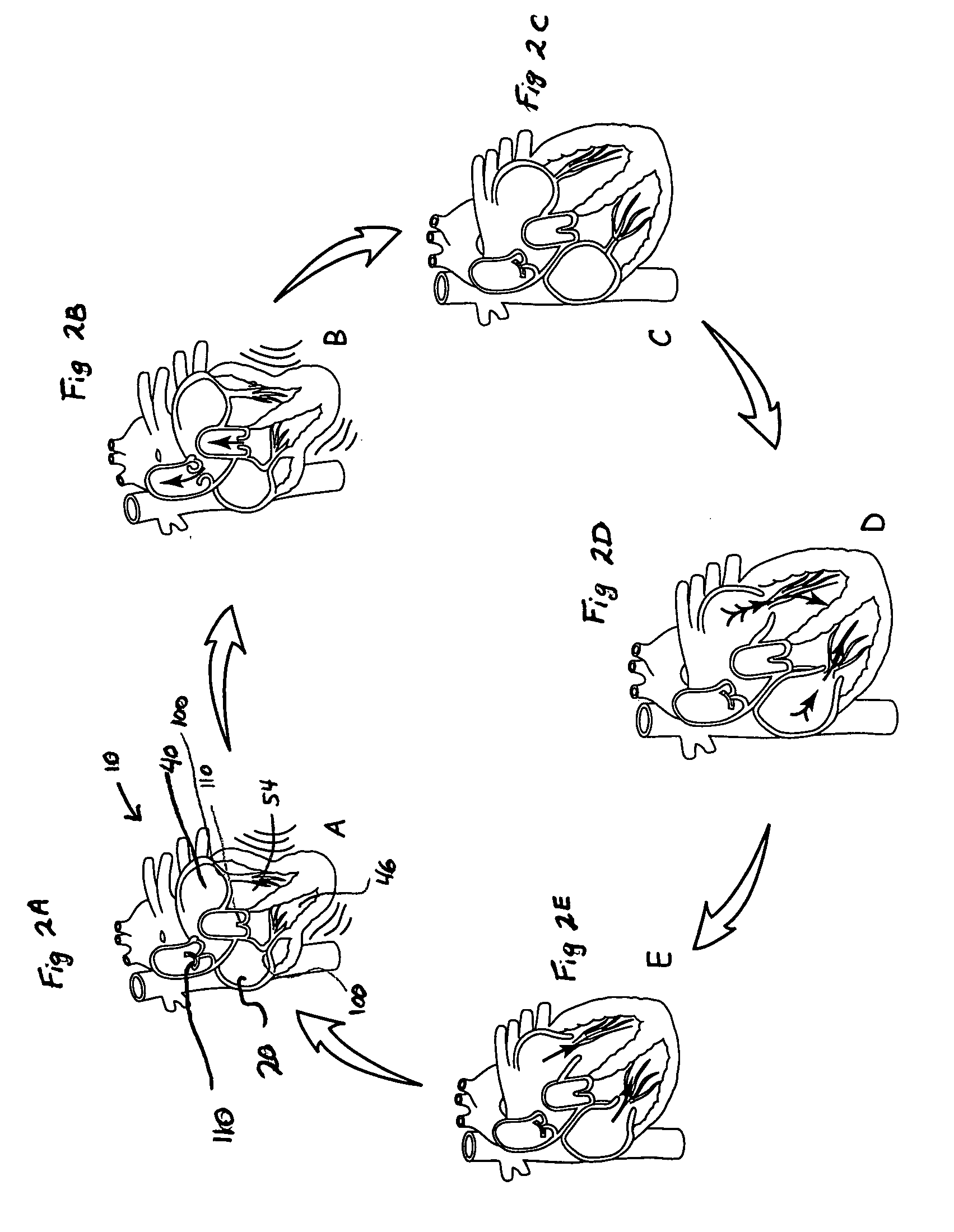 System and method of AV interval selection in an implantable medical device