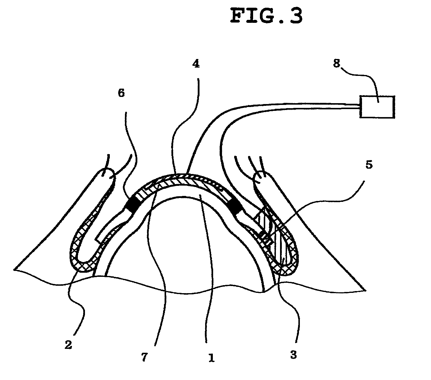 Method of measuring electrical resistance value of corneal trans-epithelium