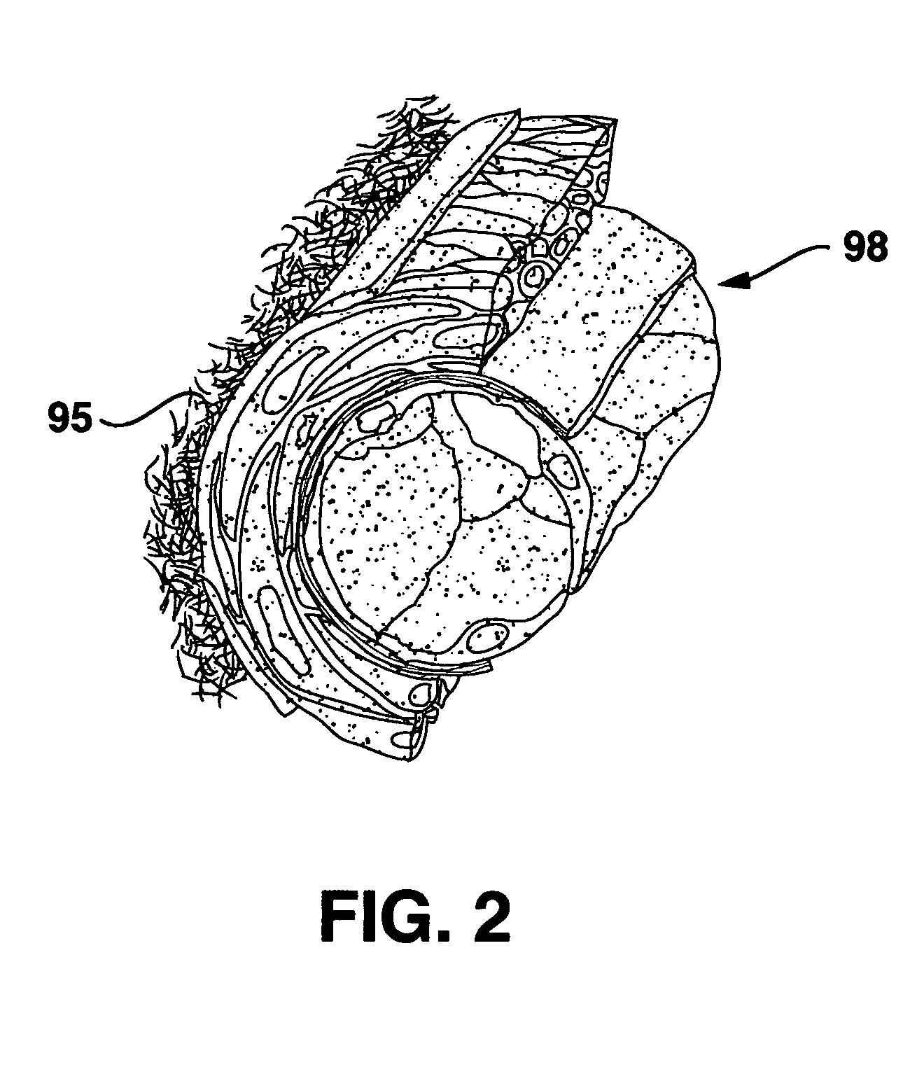 Compliant venous graft