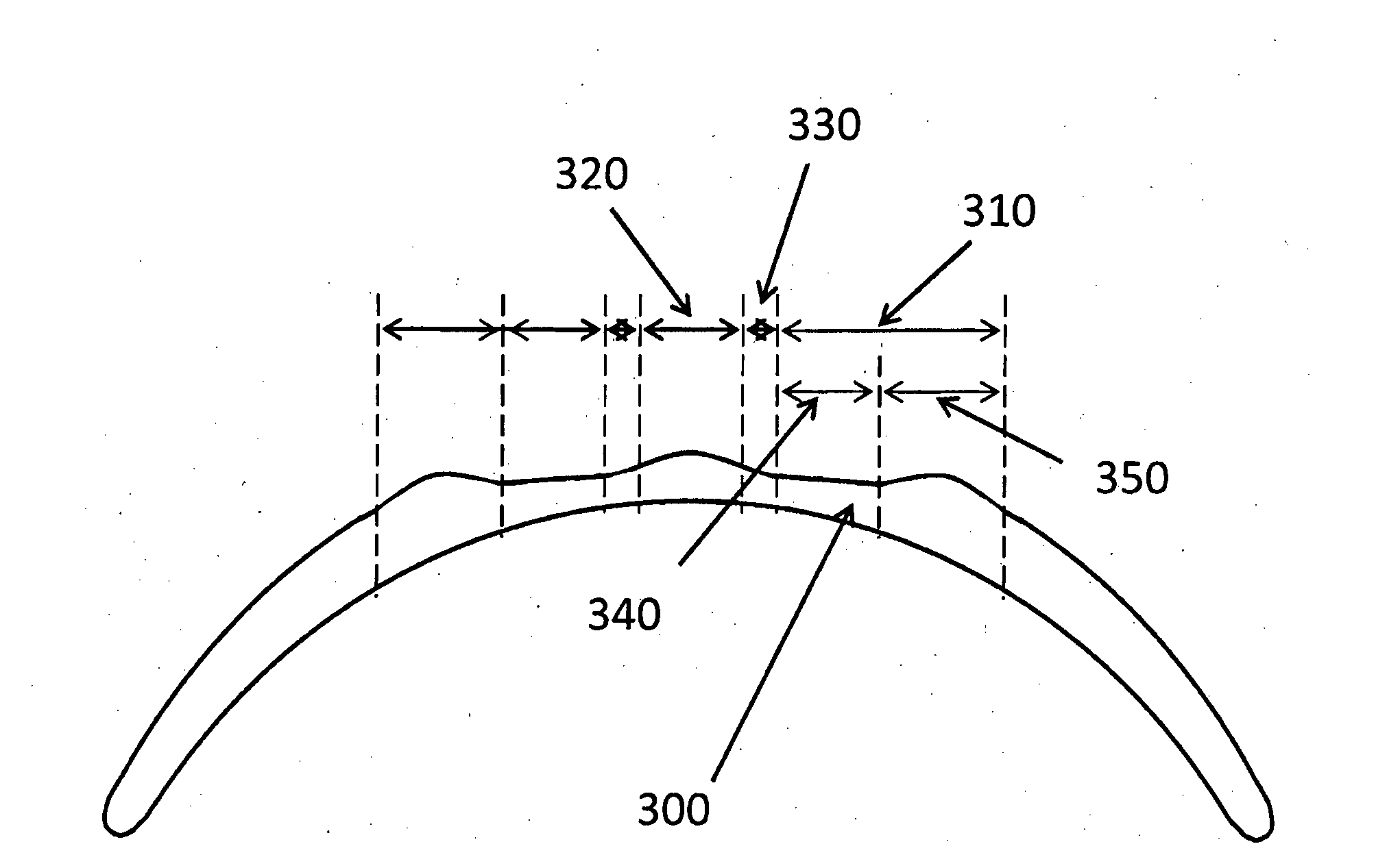 Corneal remodelling contact lenses and methods of treating refractive error using corneal remodelling