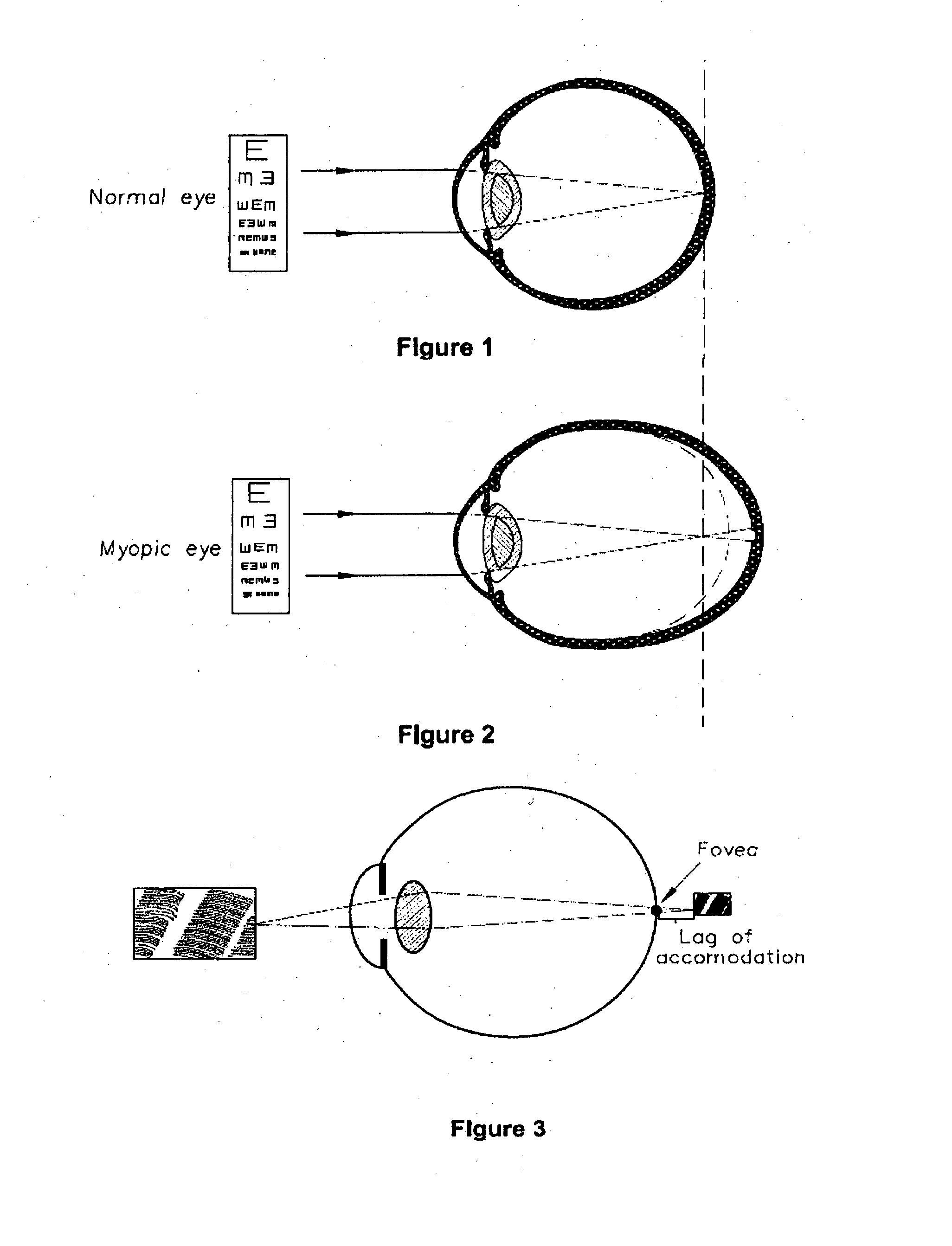 Corneal remodelling contact lenses and methods of treating refractive error using corneal remodelling