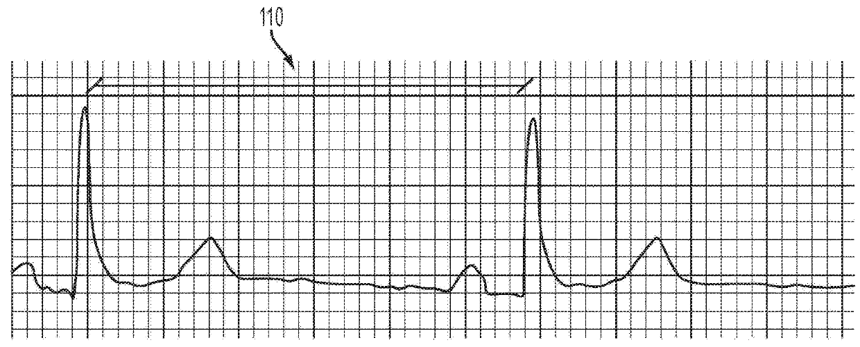 Methods And Systems For Predicting Hypovolemic Hypotensive Conditions Resulting From Bradycardia Behavior Using A Pulse Volume Waveform